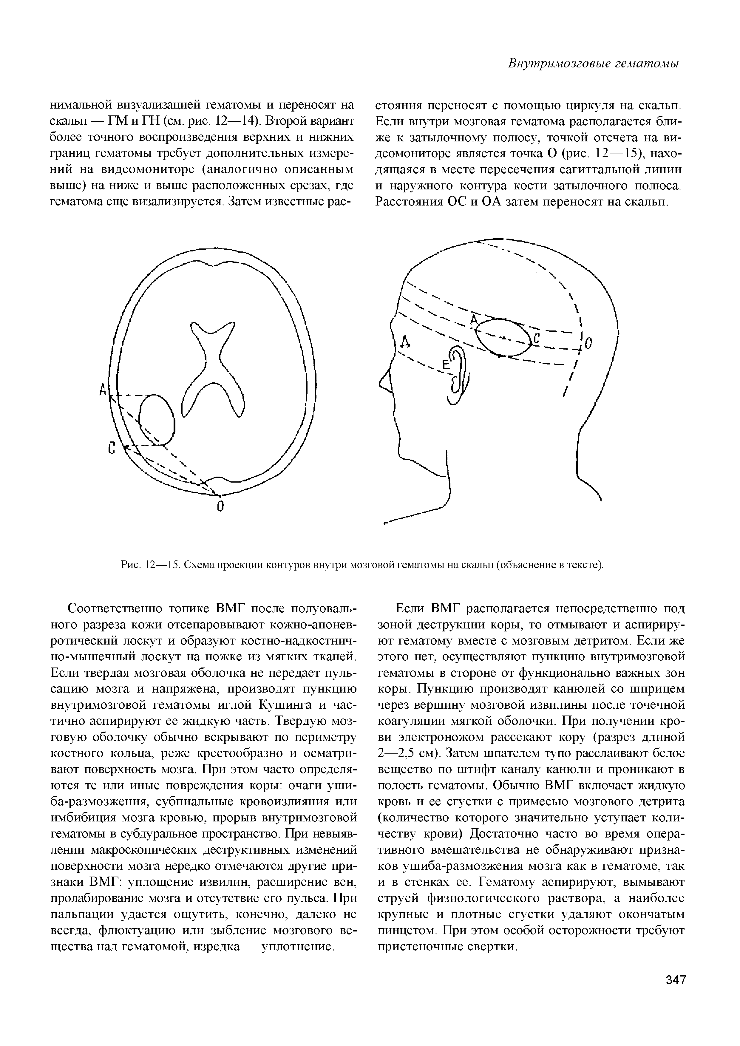 Рис. 12—15. Схема проекции контуров внутри мозговой гематомы на скальп (объяснение в тексте).