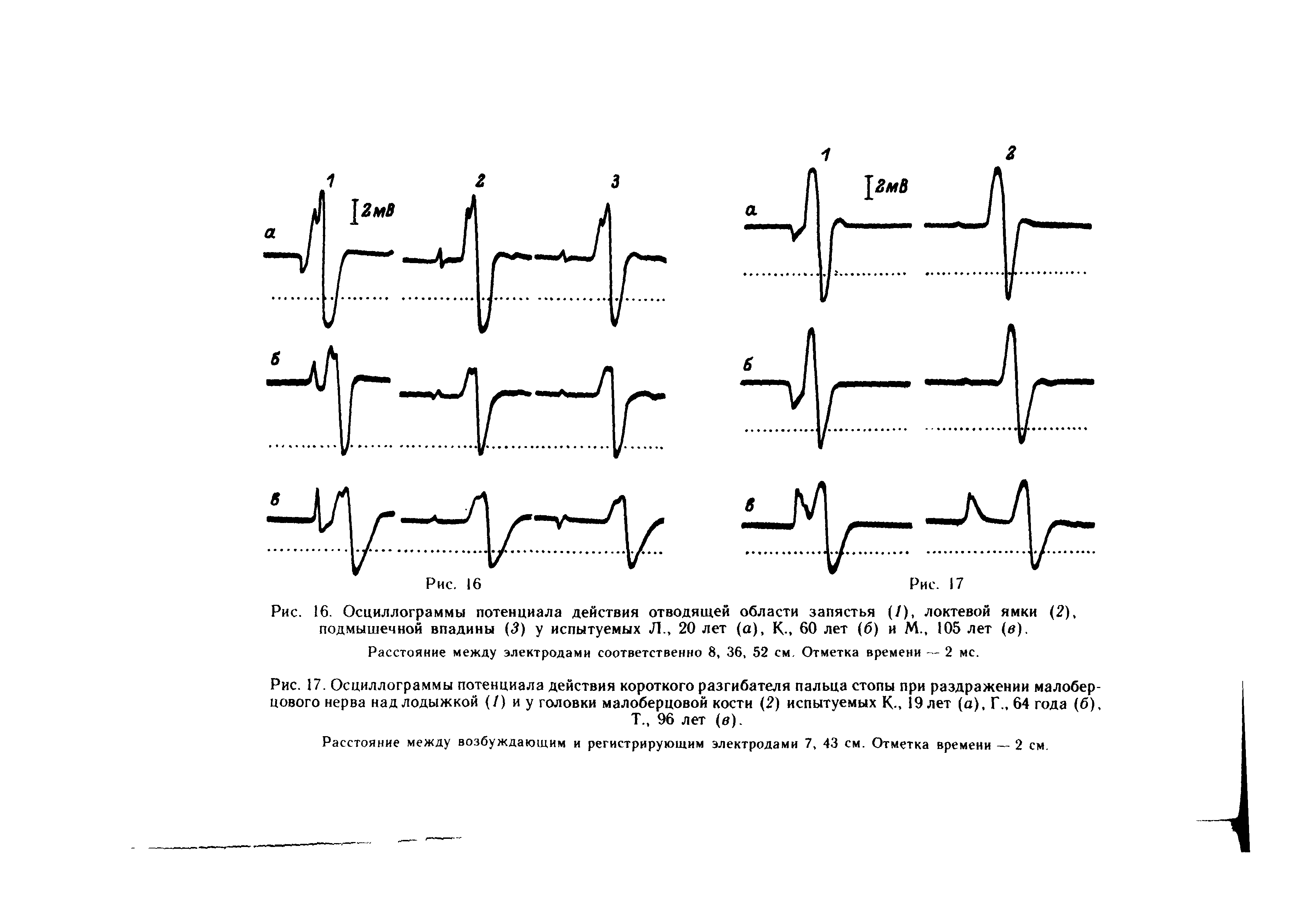 Рис. 16. Осциллограммы потенциала действия отводящей области запястья (/), локтевой ямки (2), подмышечной впадины (3) у испытуемых Л., 20 лет (а), К-, 60 лет (6) и М., I05 лет (д).