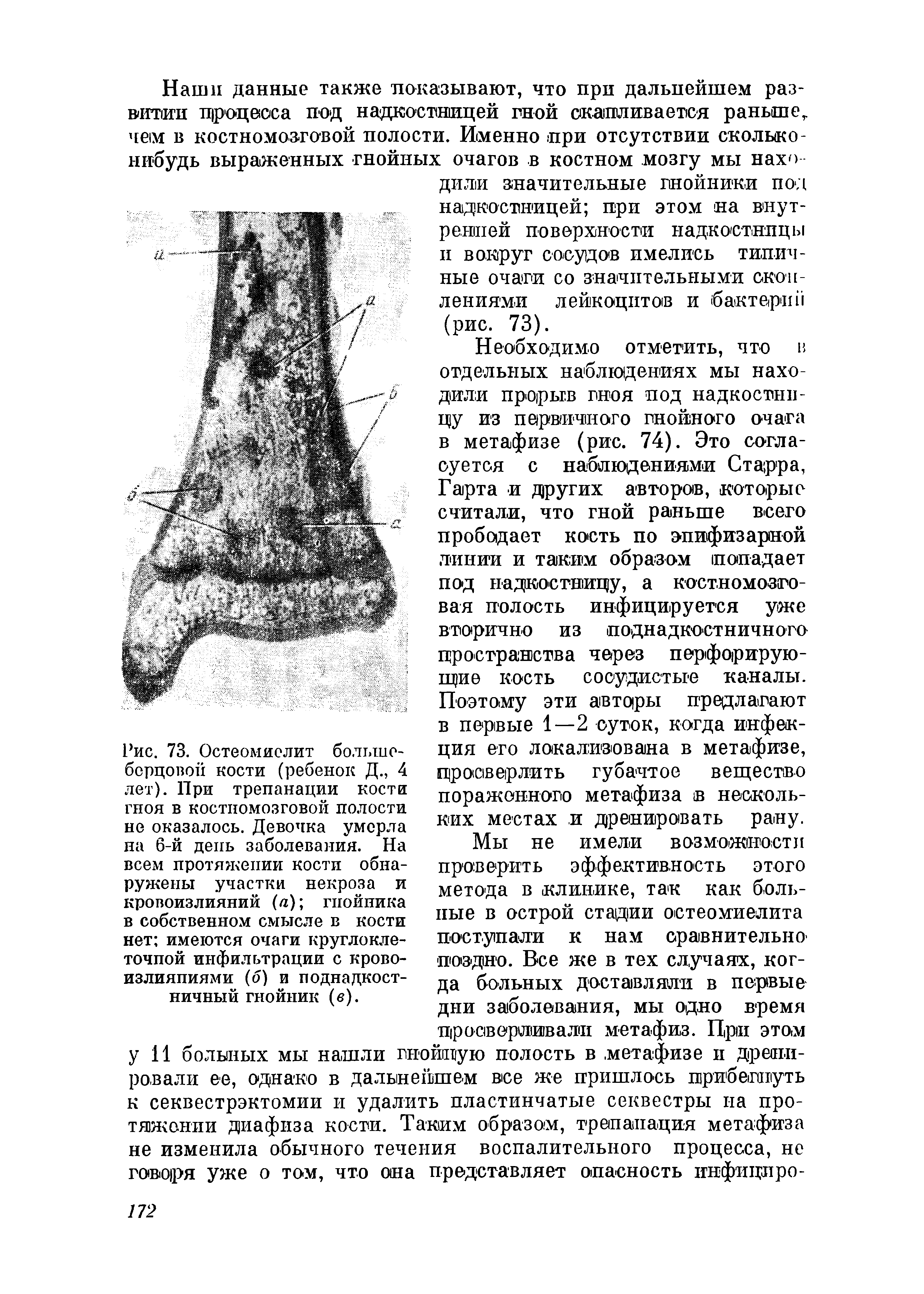 Рис. 73. Остеомиелит большеберцовой кости (ребенок Д., 4 лет). При трепанации кости гноя в костномозговой полости не оказалось. Девочка умерла на 6-й день заболевания. На всем протяжении кости обнаружены участки некроза и кровоизлияний (/г) гнойника в собственном смысле в кости...