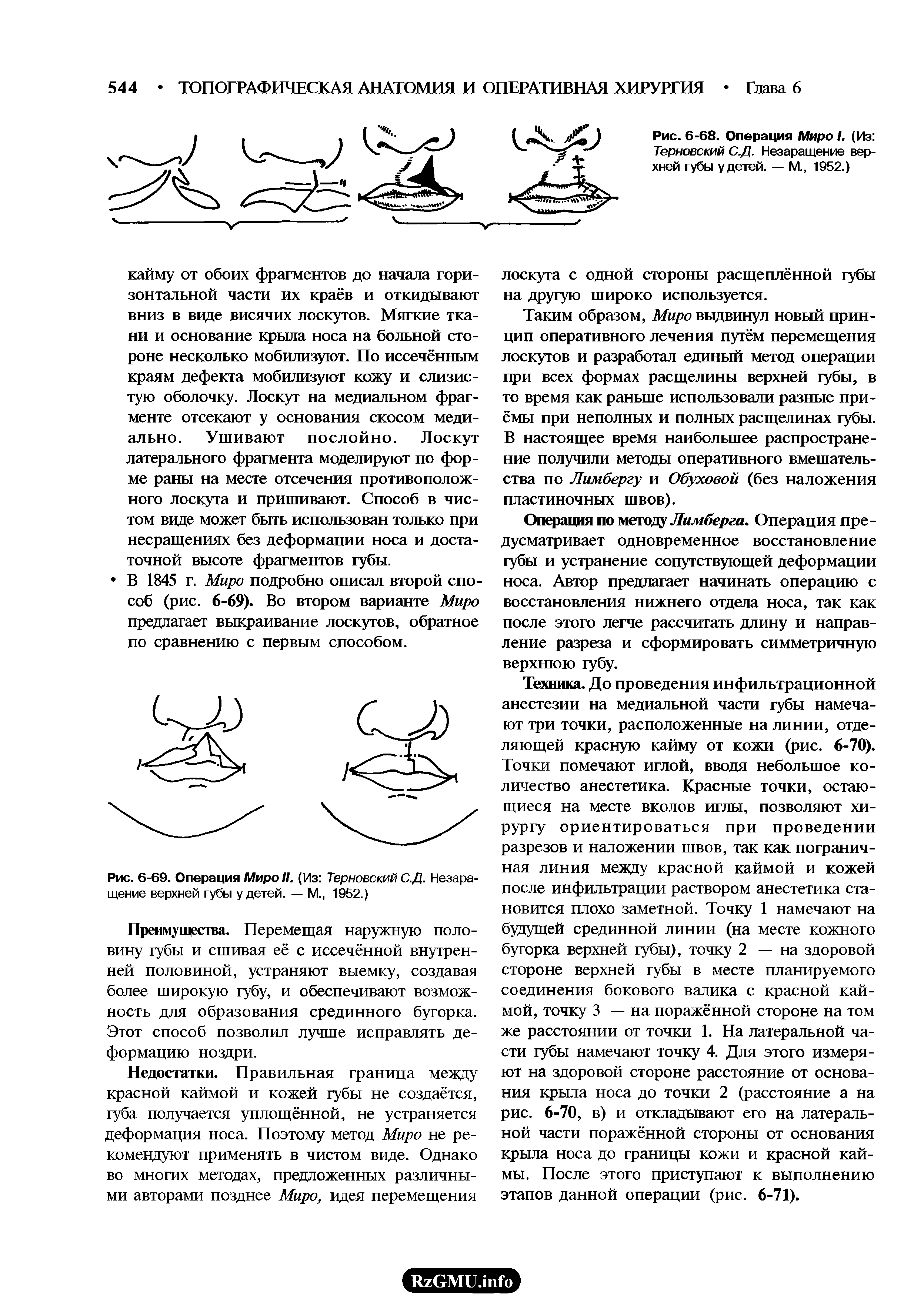 Рис. 6-69. Операция МироН. (Из Терновский С.Д. Незаращение верхней губы у детей. — М., 1952.)...