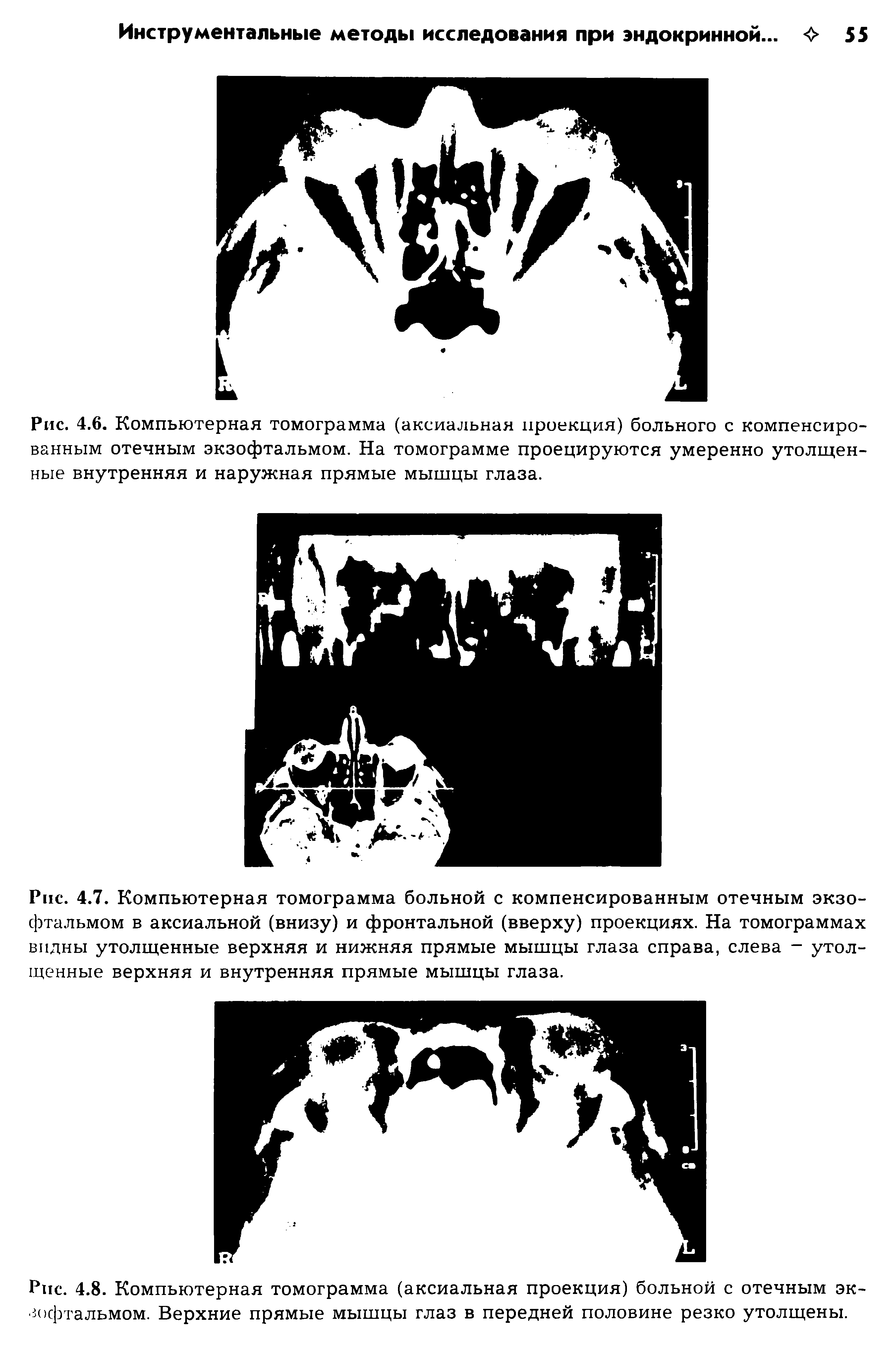 Рис. 4.8. Компьютерная томограмма (аксиальная проекция) больной с отечным экзофтальмом. Верхние прямые мышцы глаз в передней половине резко утолщены.