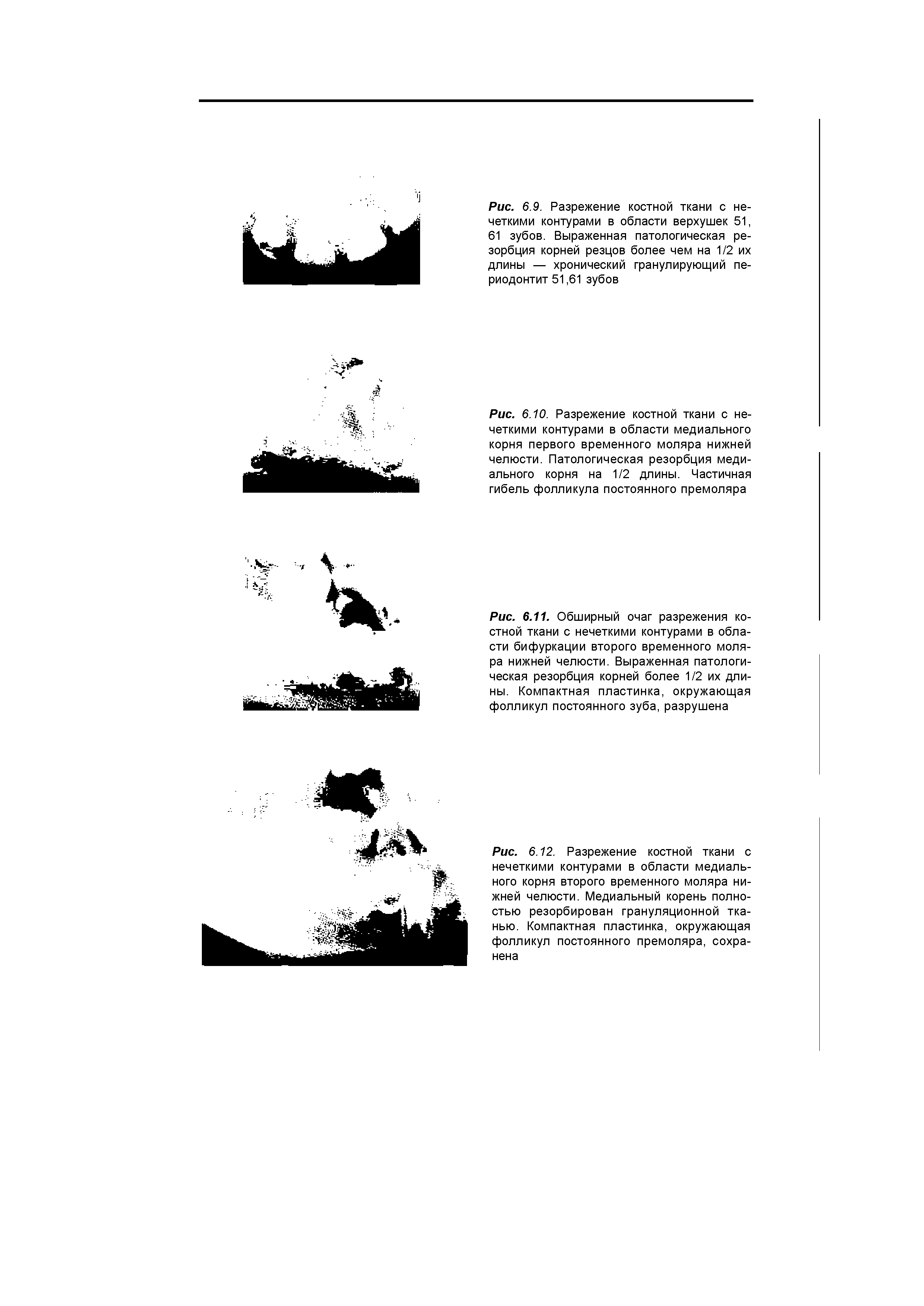 Рис. 6.10. Разрежение костной ткани с нечеткими контурами в области медиального корня первого временного моляра нижней челюсти. Патологическая резорбция медиального корня на 1/2 длины. Частичная гибель фолликула постоянного премоляра...