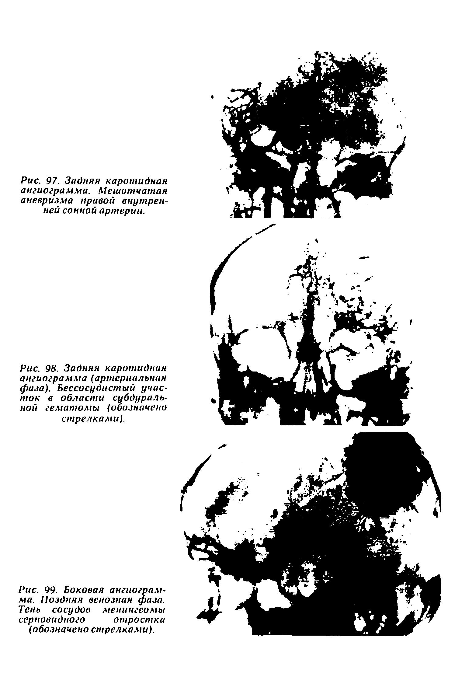 Рис. 99. Боковая ангиограмма. Поздняя венозная фаза. Тень сосудов менингеомы серповидного отростка (обозначено стрелками).