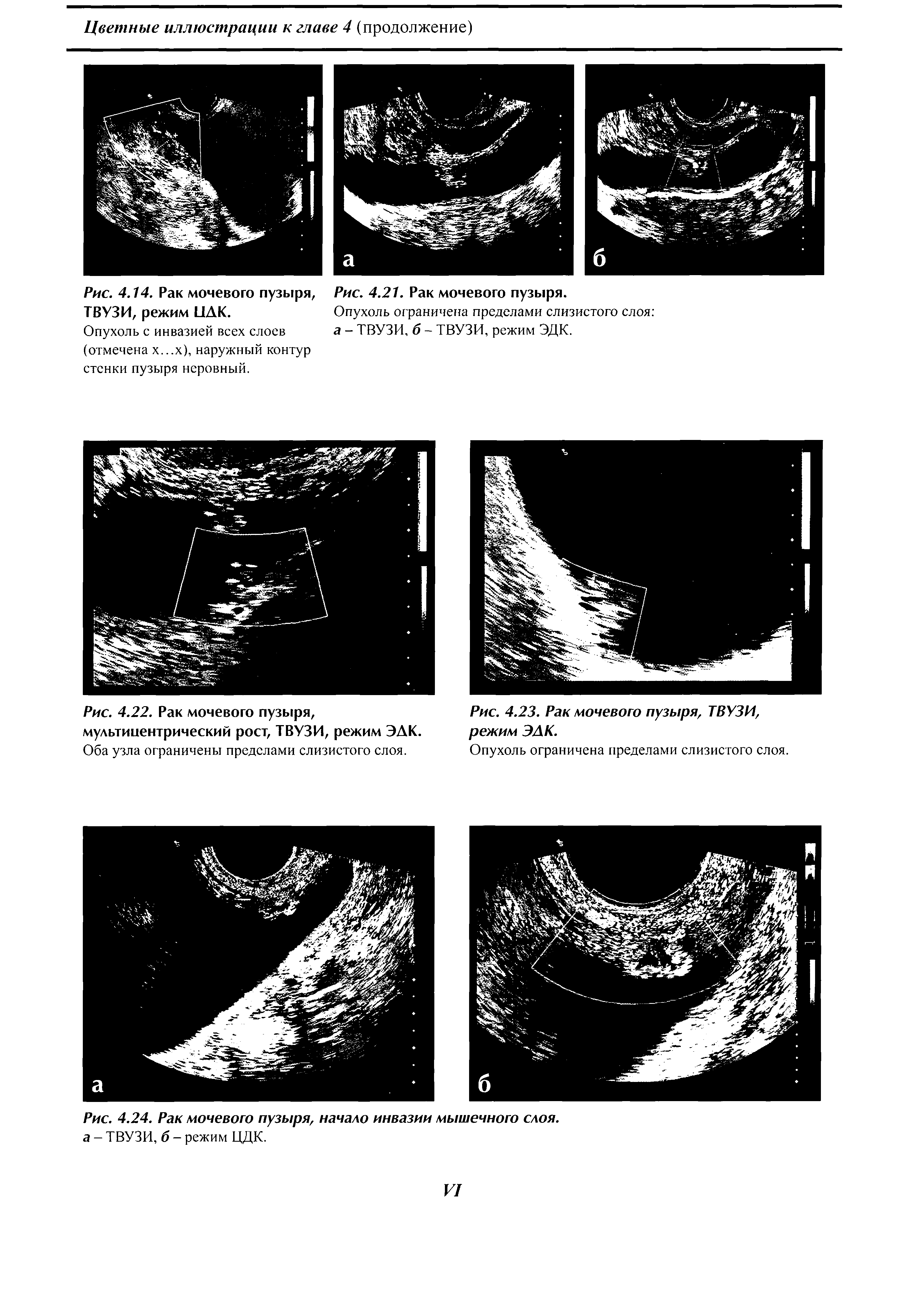Рис. 4.24. Рак мочевого пузыря, начало инвазии мышечного слоя, а - ТВУЗИ, б - режим ЦДК.