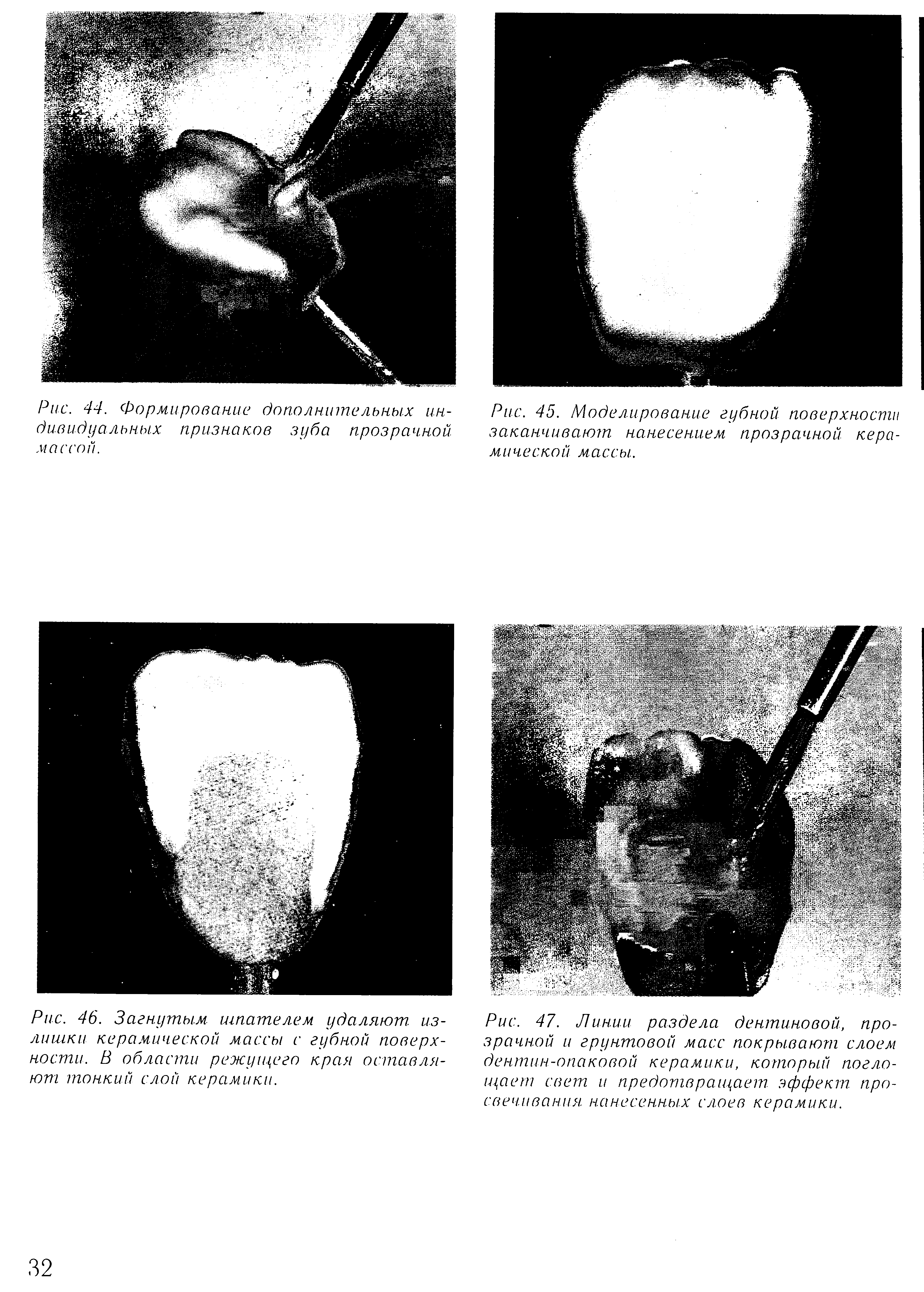 Рис. 45. Моделирование губной поверхности заканчивают нанесением прозрачной керамической массы.