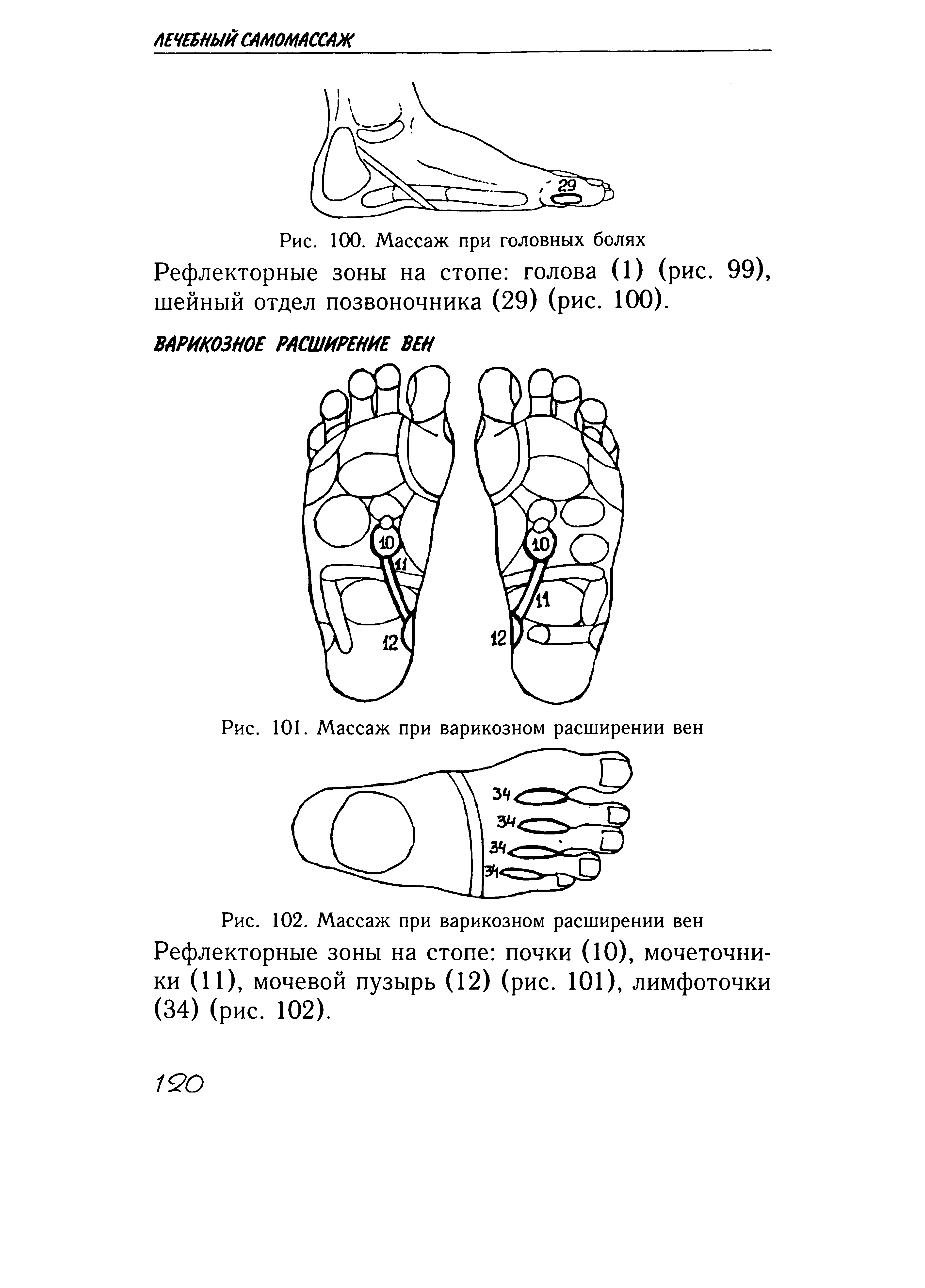 Рис. 102. Массаж при варикозном расширении вен Рефлекторные зоны на стопе почки (10), мочеточники (11), мочевой пузырь (12) (рис. 101), лимфоточки (34) (рис. 102).