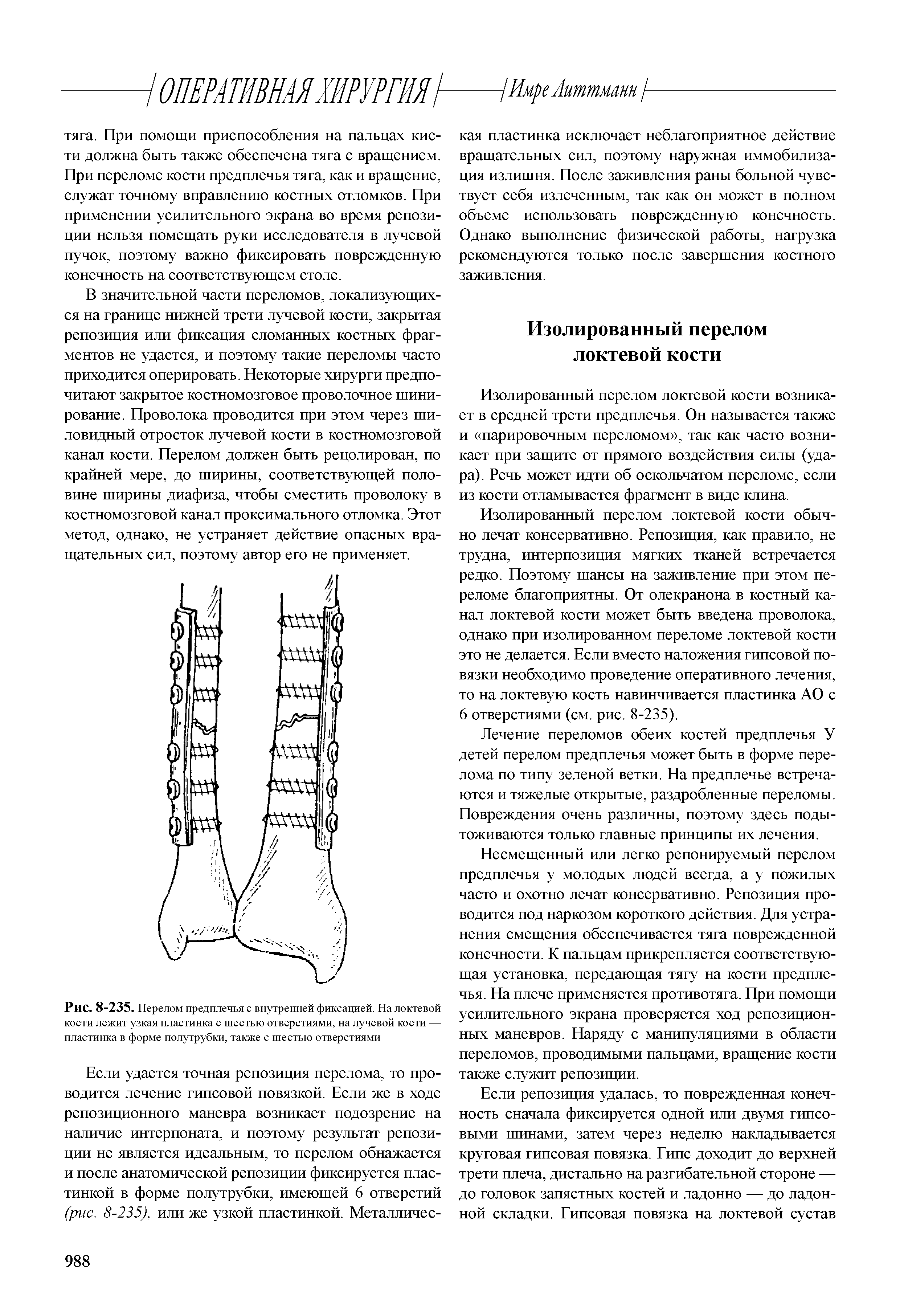 Рис. 8-235. Перелом предплечья с внутренней фиксацией. На локтевой кости лежит узкая пластинка с шестью отверстиями, на лучевой кости — пластинка в форме полутрубки, также с шестью отверстиями...