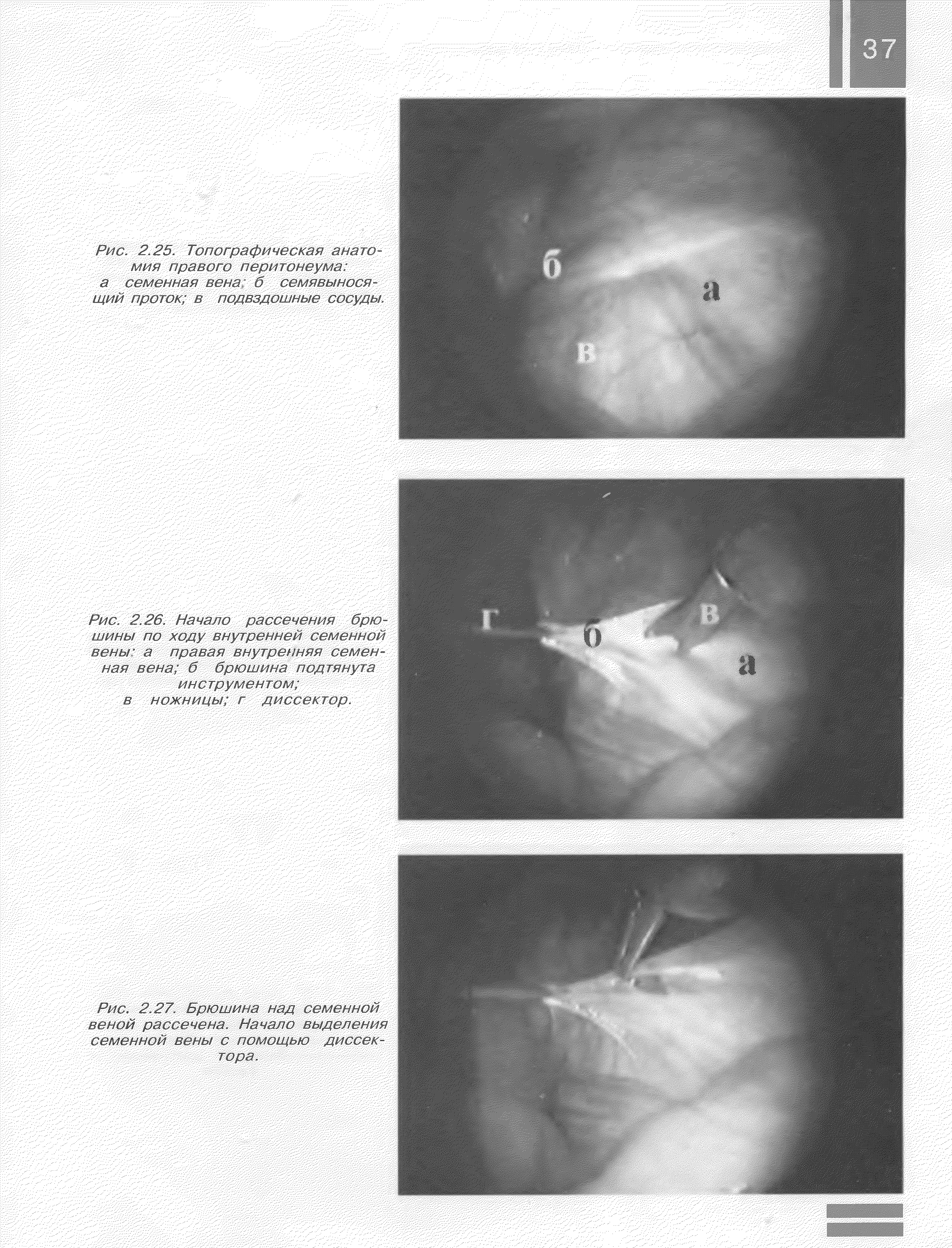 Рис. 2.27. Брюшина над семенной веной рассечена. Начало выделения семенной вены с помощью диссек-...