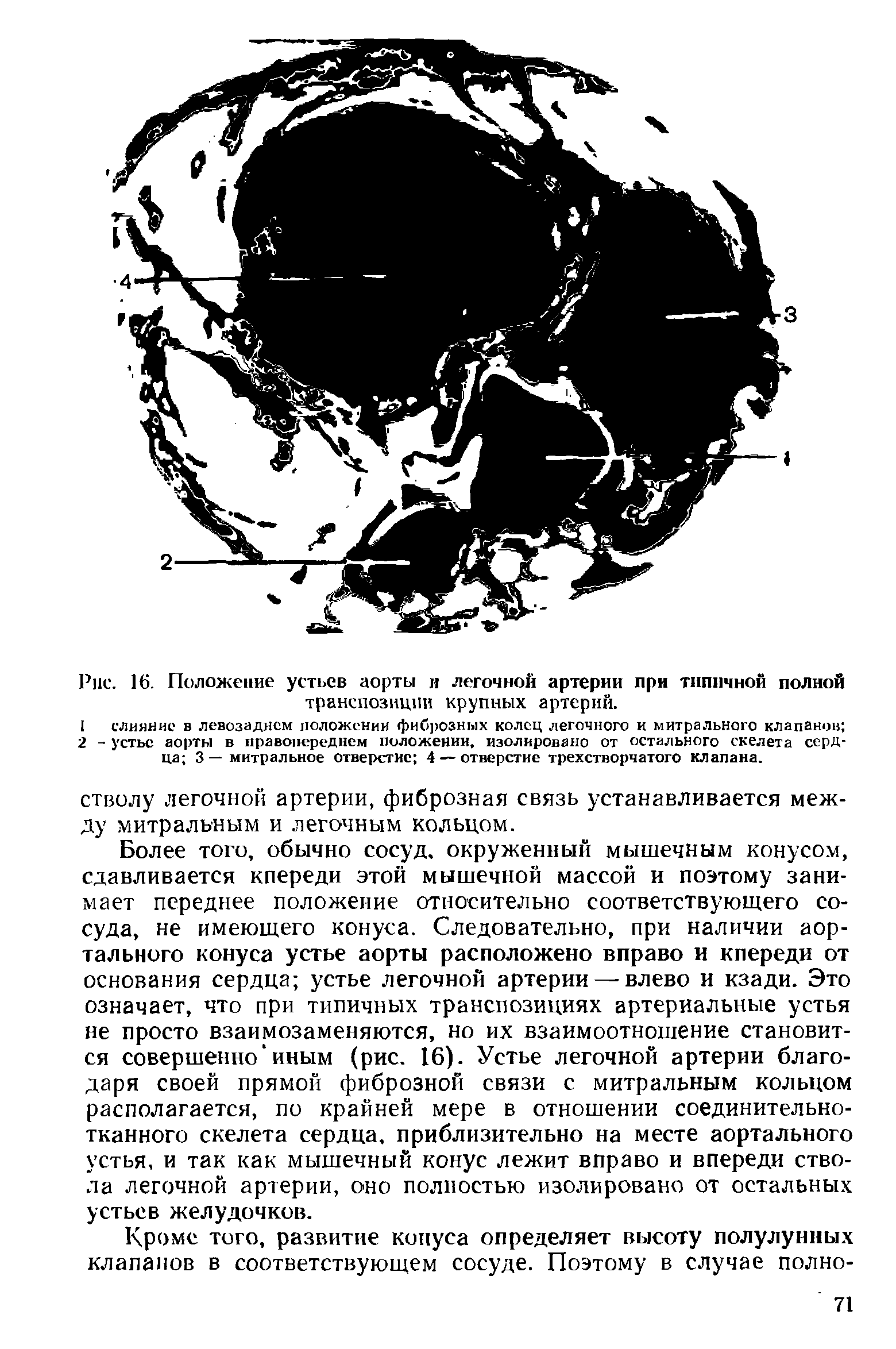 Рис. 16. Положение устьев аорты и легочной артерии при типичной полной транспозиции крупных артерий.