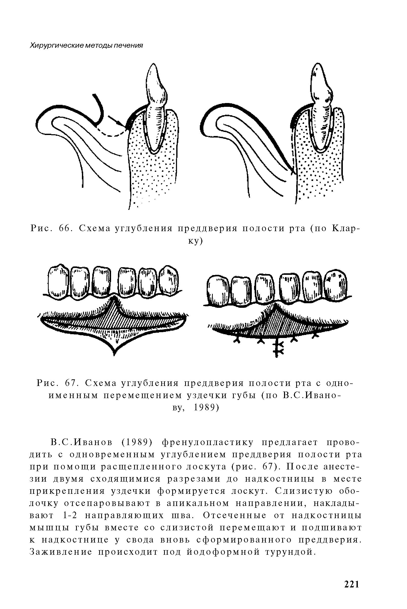 Рис. 67. Схема углубления преддверия полости рта с одноименным перемещением уздечки губы (по В.С.Иванову, 1989)...