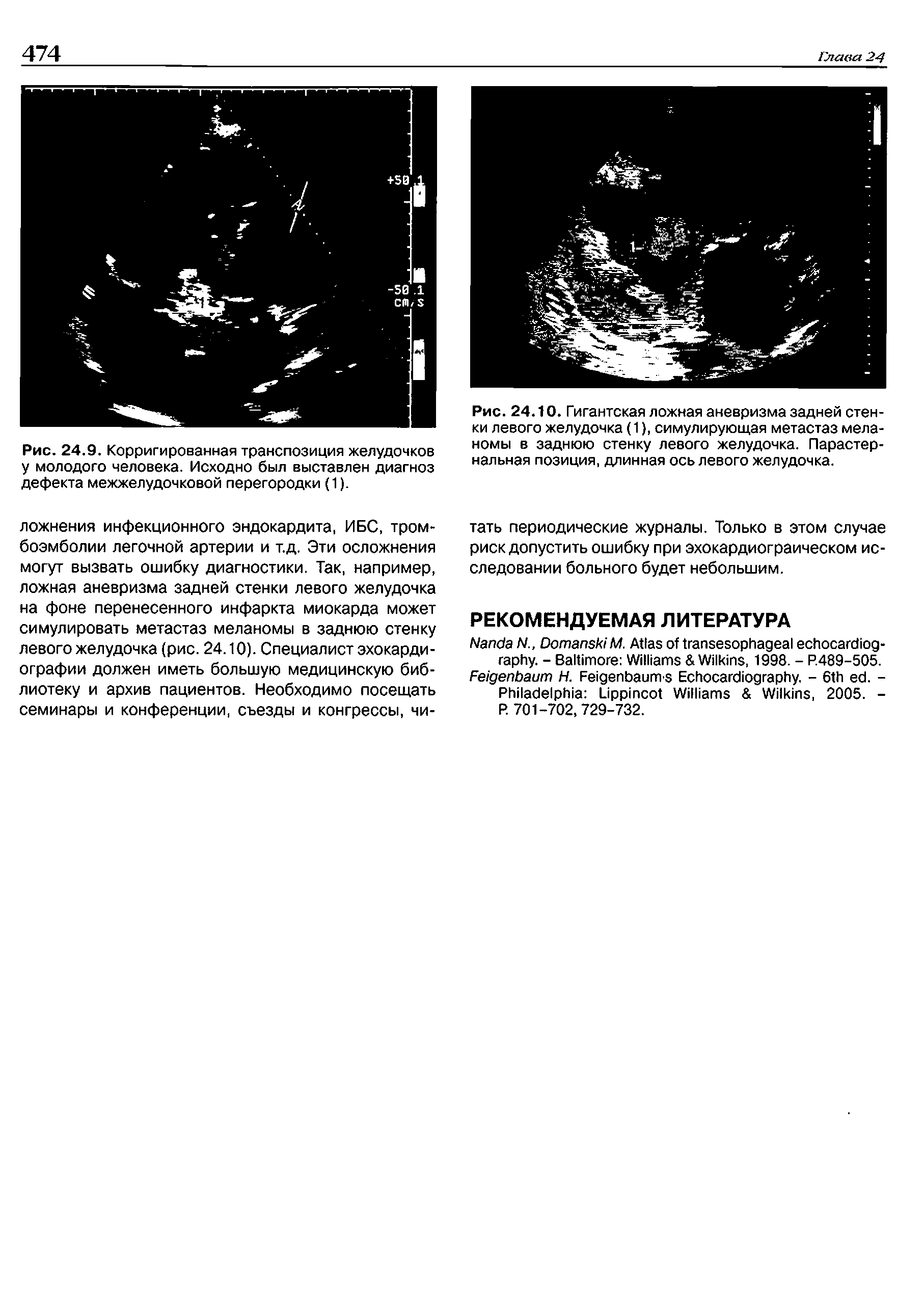 Рис. 24.9. Корригированная транспозиция желудочков у молодого человека. Исходно был выставлен диагноз дефекта межжелудочковой перегородки (1).