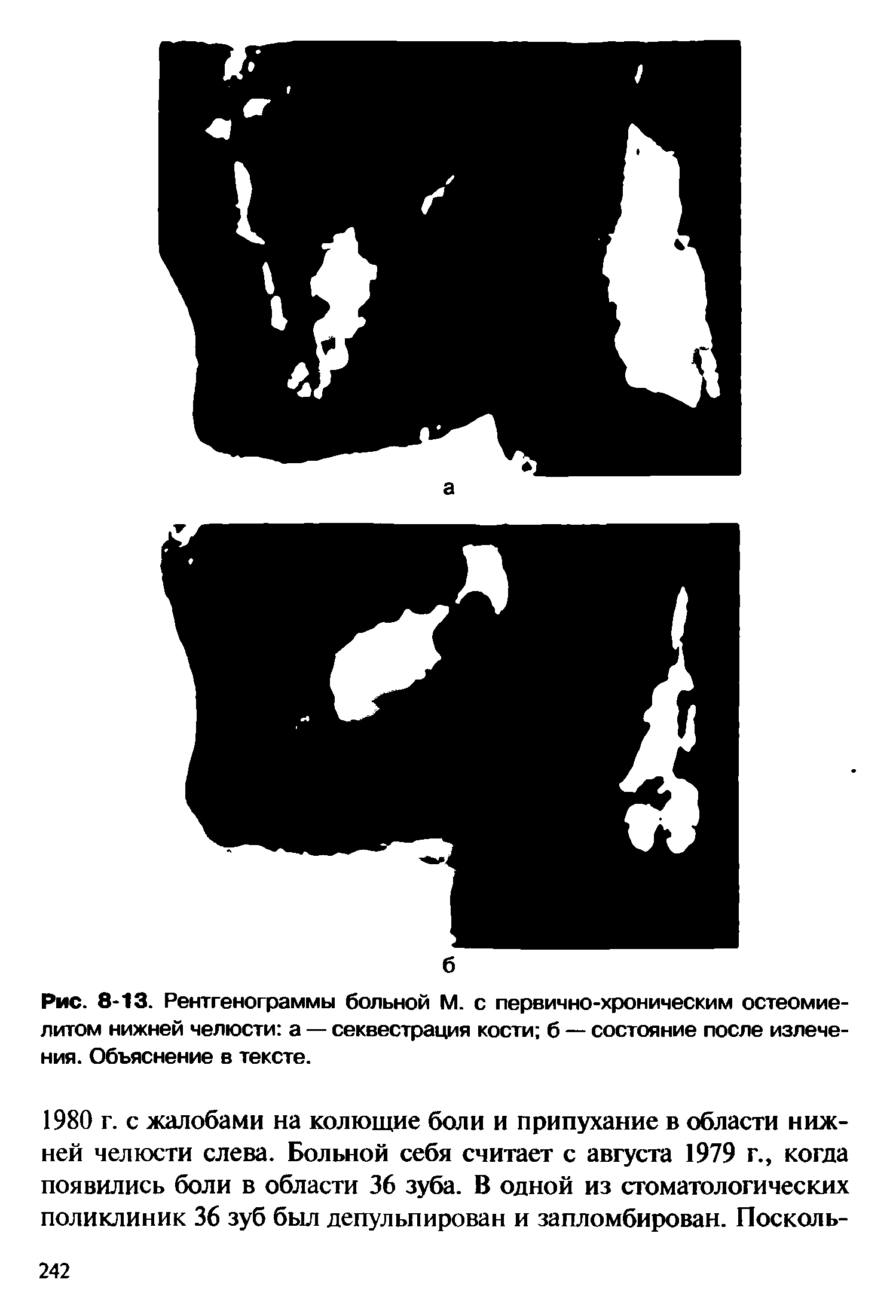 Рис. 8-13. Рентгенограммы больной М. с первично-хроническим остеомиелитом нижней челюсти а — секвестрация кости б — состояние после излечения. Объяснение в тексте.
