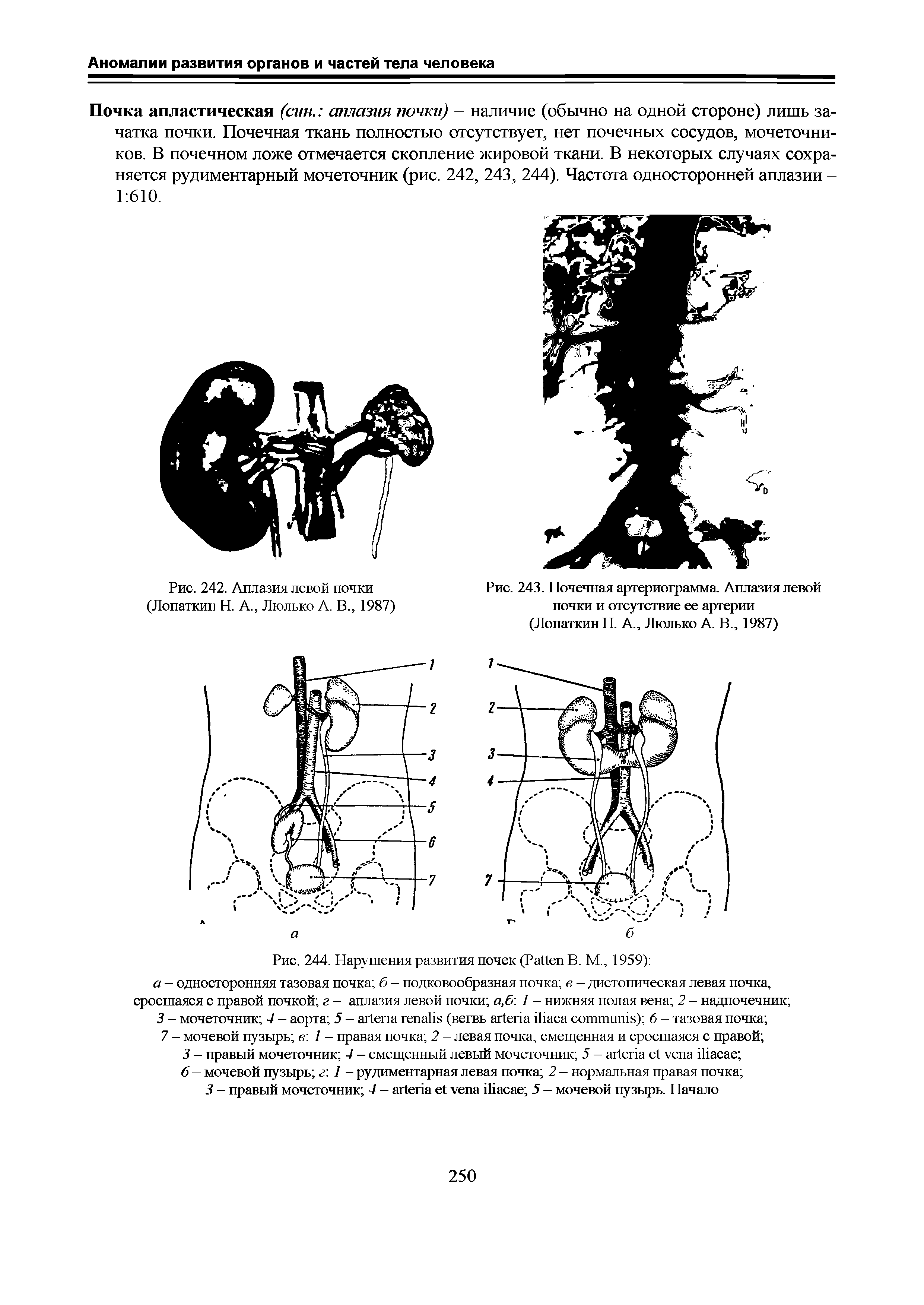 Рис. 244. Нарушения развития почек (P В. М., 1959) а — односторонняя тазовая почка б — подковообразная почка в — дистопическая левая почка, сросшаяся с правой почкой г — аплазия левой почки а,б 1 — нижняя полая вена 2 — надпочечник ...