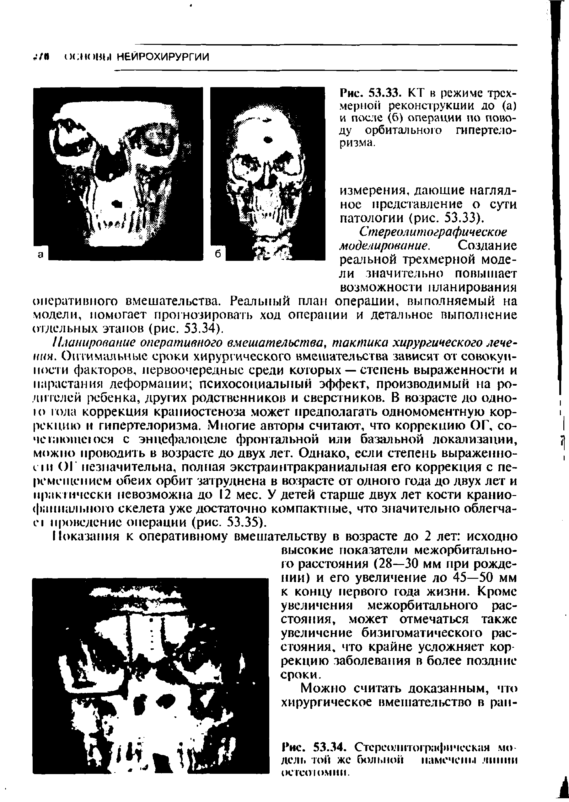 Рис. 53.34. Стереолитографическая модель той же больной намечены линии остеотомии.