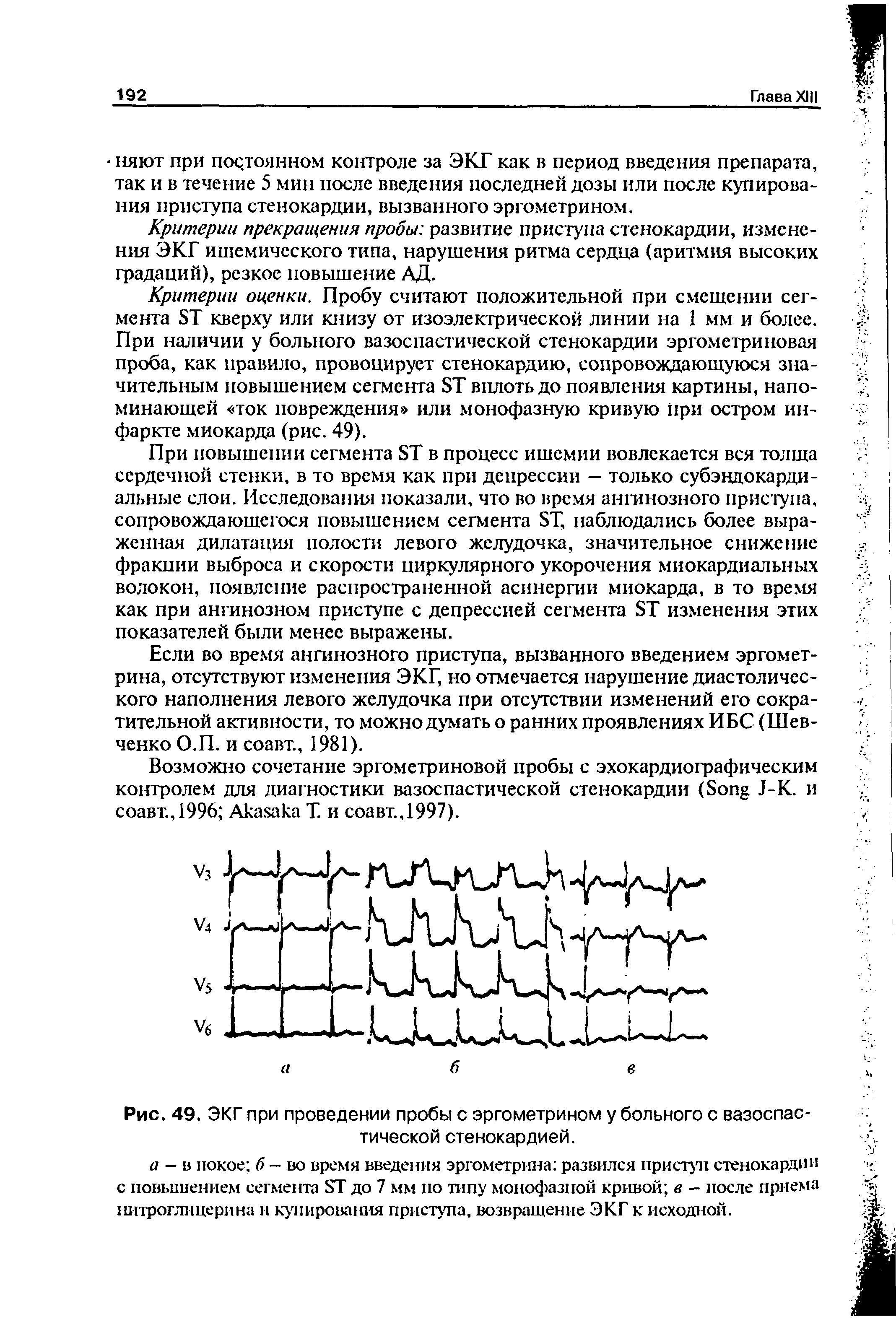 Рис. 49. ЭКГ при проведении пробы с эргометрином у больного с вазоспастической стенокардией.