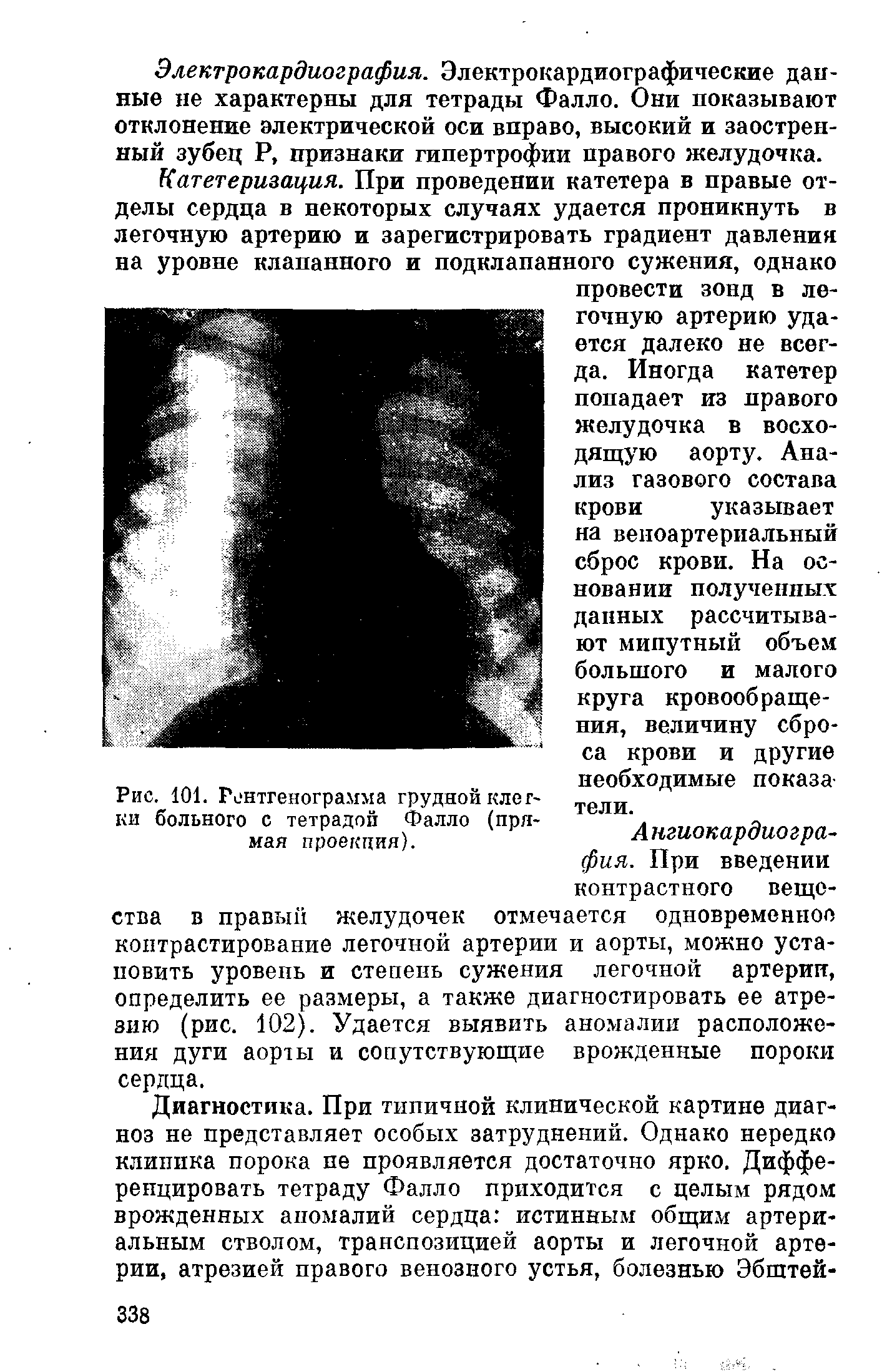 Рис. 101. Рентгенограмма грудной клетки больного с тетрадой Фалло (прямая проекция).