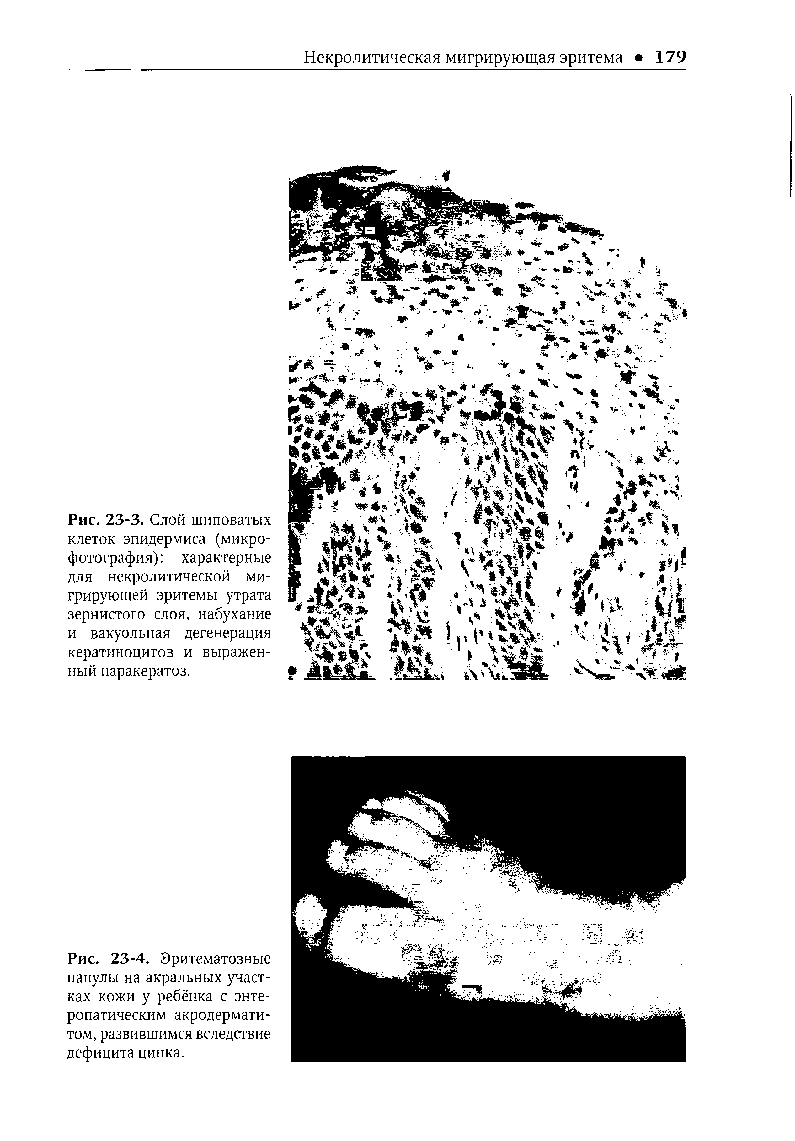 Рис. 23-3. Слой шиповатых клеток эпидермиса (микрофотография) характерные для некролитической мигрирующей эритемы утрата зернистого слоя, набухание и вакуольная дегенерация кератиноцитов и выраженный паракератоз.