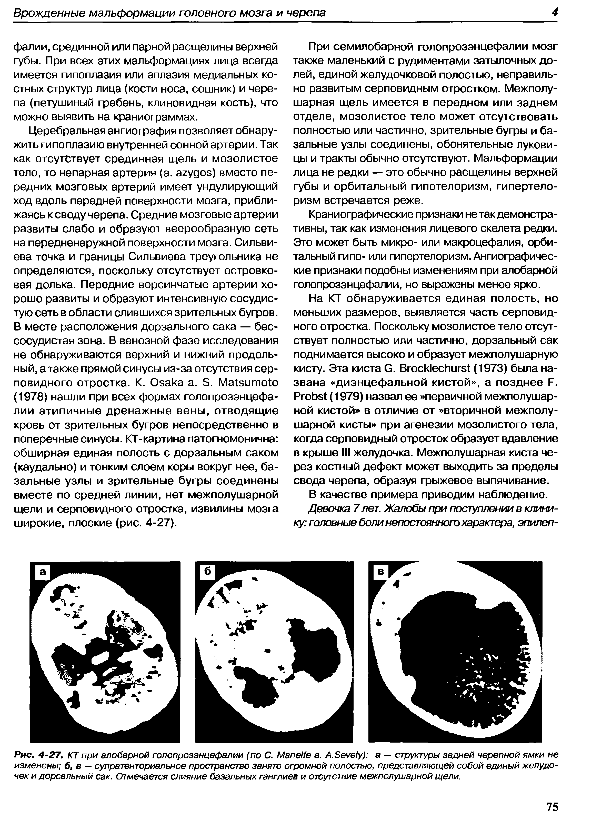 Рис. 4-27. КТ при алобарной голопрозэнцефалии (по С. МапеНе а. А.3еуе1у) а — структуры задней черепной ямки не изменены б, в — супратенториальное пространство занято огромной полостью, представляющей собой единый желудочек и дорсальный сак. Отмечается слияние базальных ганглиев и отсутствие межполушарной щели.