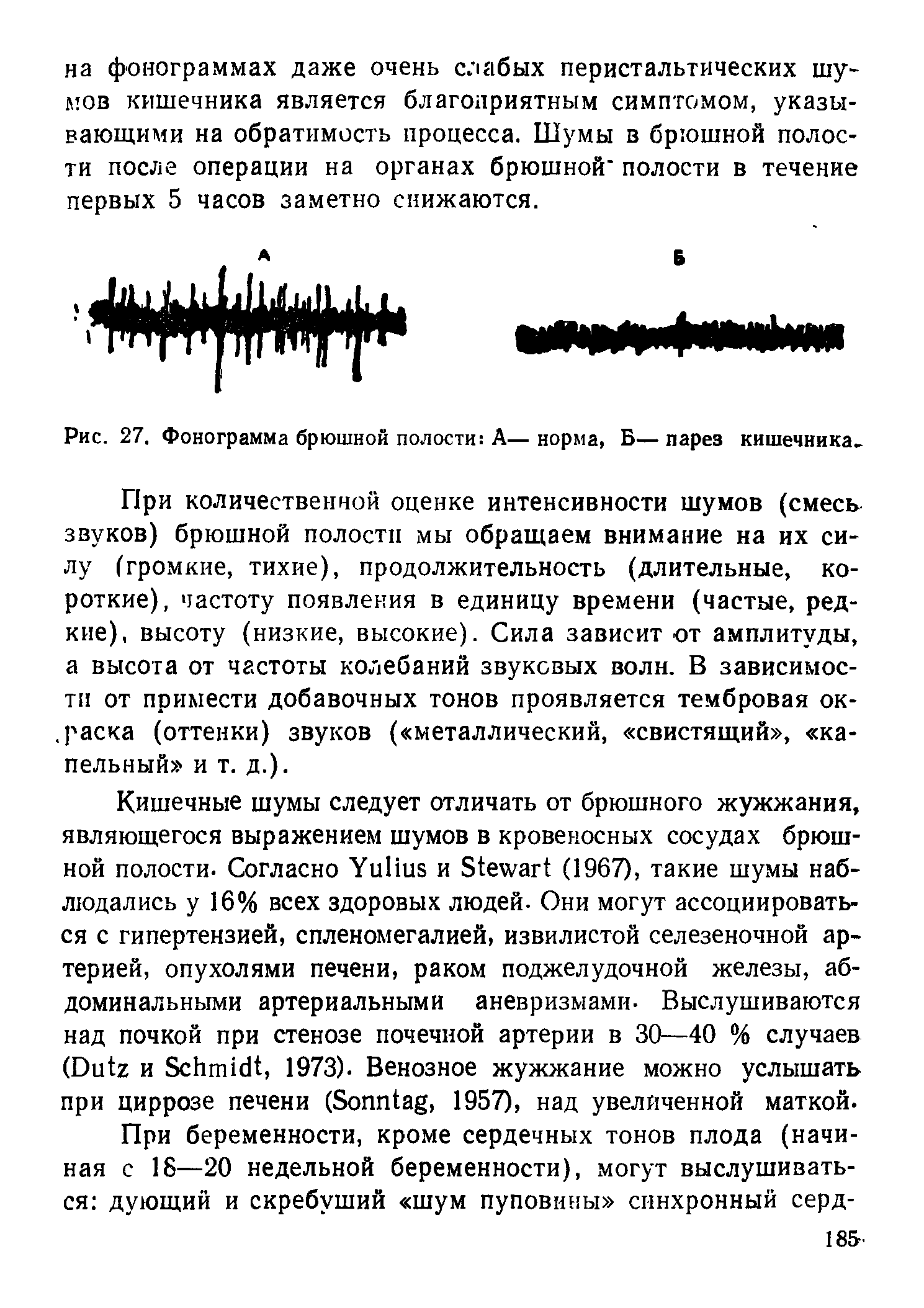 Рис. 27. Фонограмма брюшной полости А—норма, Б—парез кишечника.