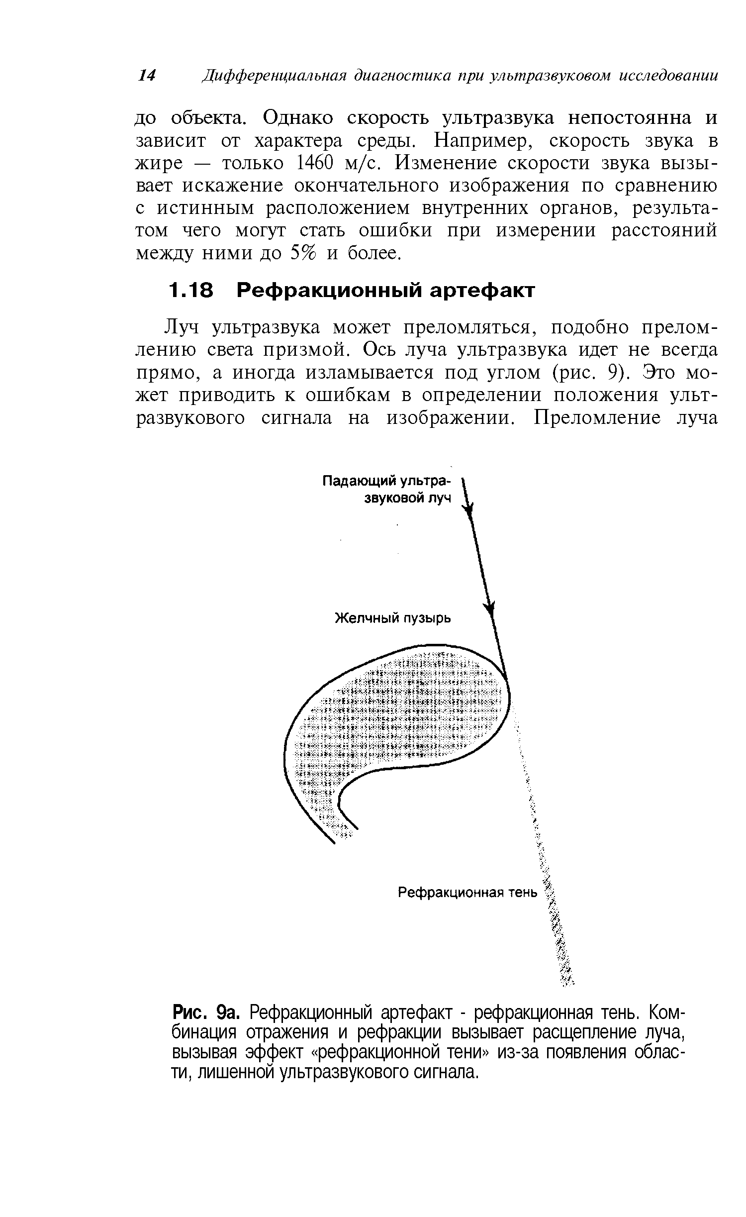 Рис. 9а. Рефракционный артефакт - рефракционная тень. Комбинация отражения и рефракции вызывает расщепление луча, вызывая эффект рефракционной тени из-за появления области, лишенной ультразвукового сигнала.