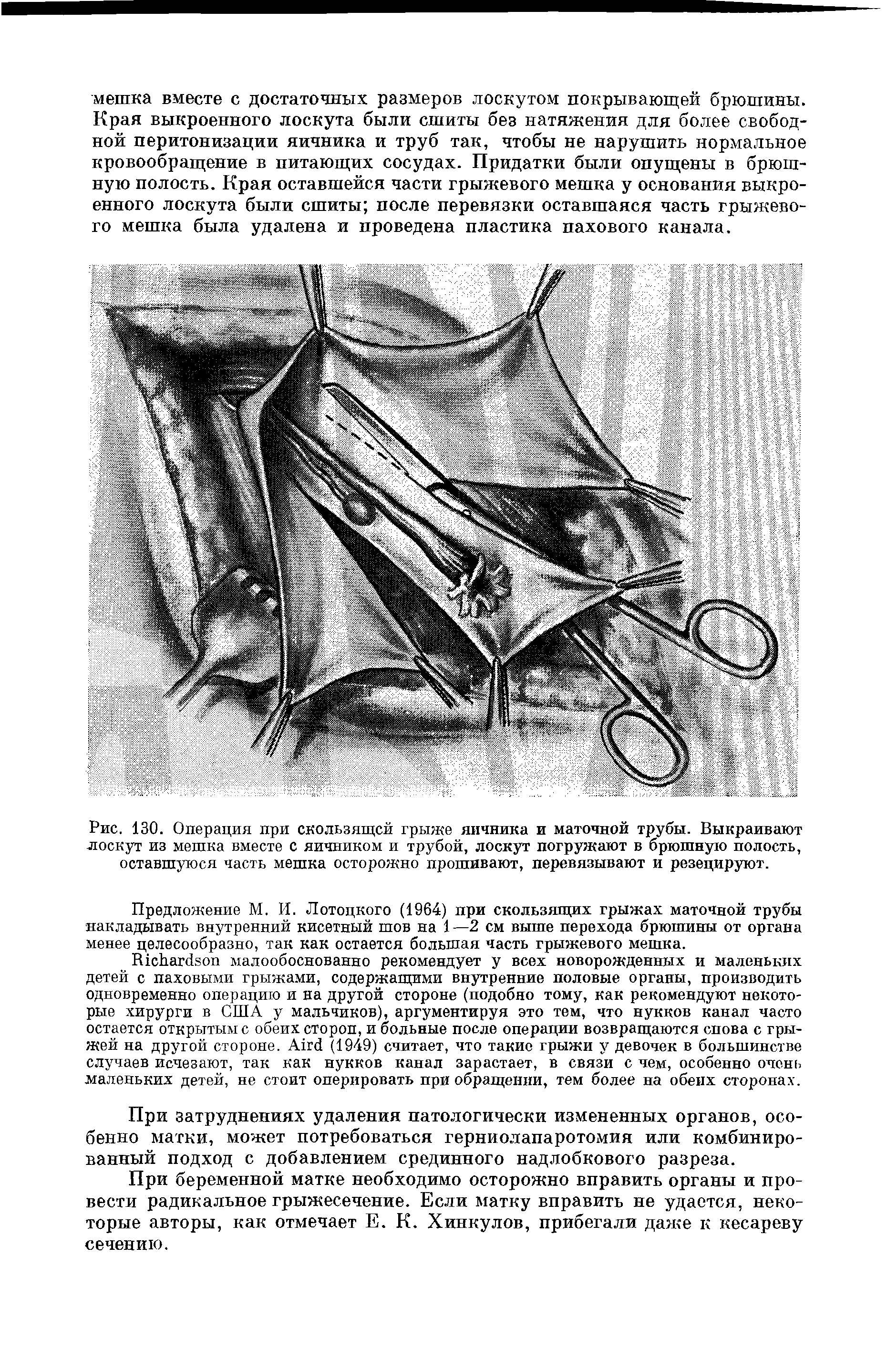 Рис. 130. Операция при скользящей грыже яичника и маточной трубы. Выкраивают лоскут из мешка вместе с яичником и трубой, лоскут погружают в брюшную полость, оставшуюся часть мешка осторожно прошивают, перевязывают и резецируют.