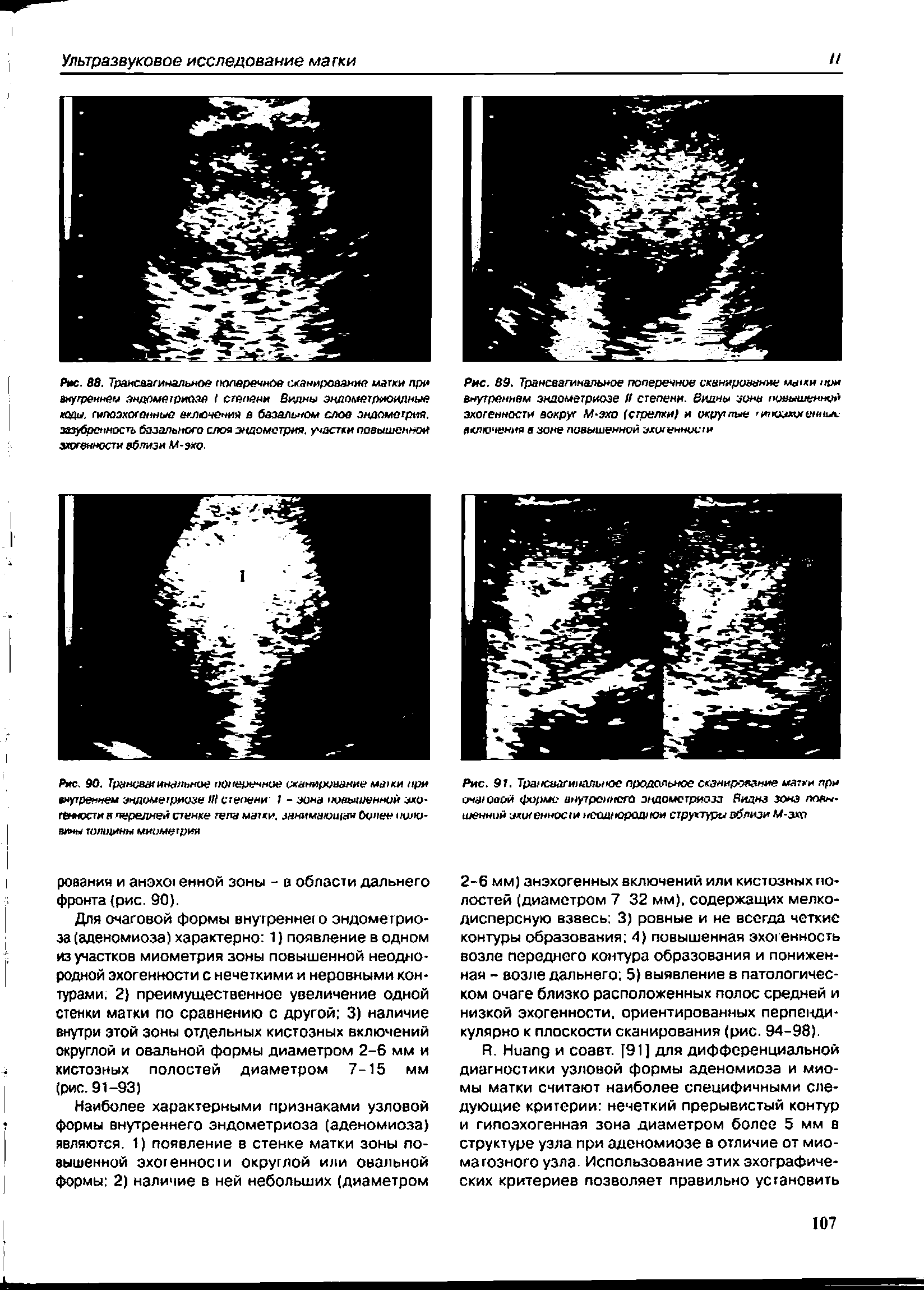 Рис. 90. Трвнсзатинальное поперечное сканирование мажи при внутреннем эндометриозе степени I - эона повышенной эхогенности я передней стенке тепа матки. занимающая Оунен -вины толщины миометрия...