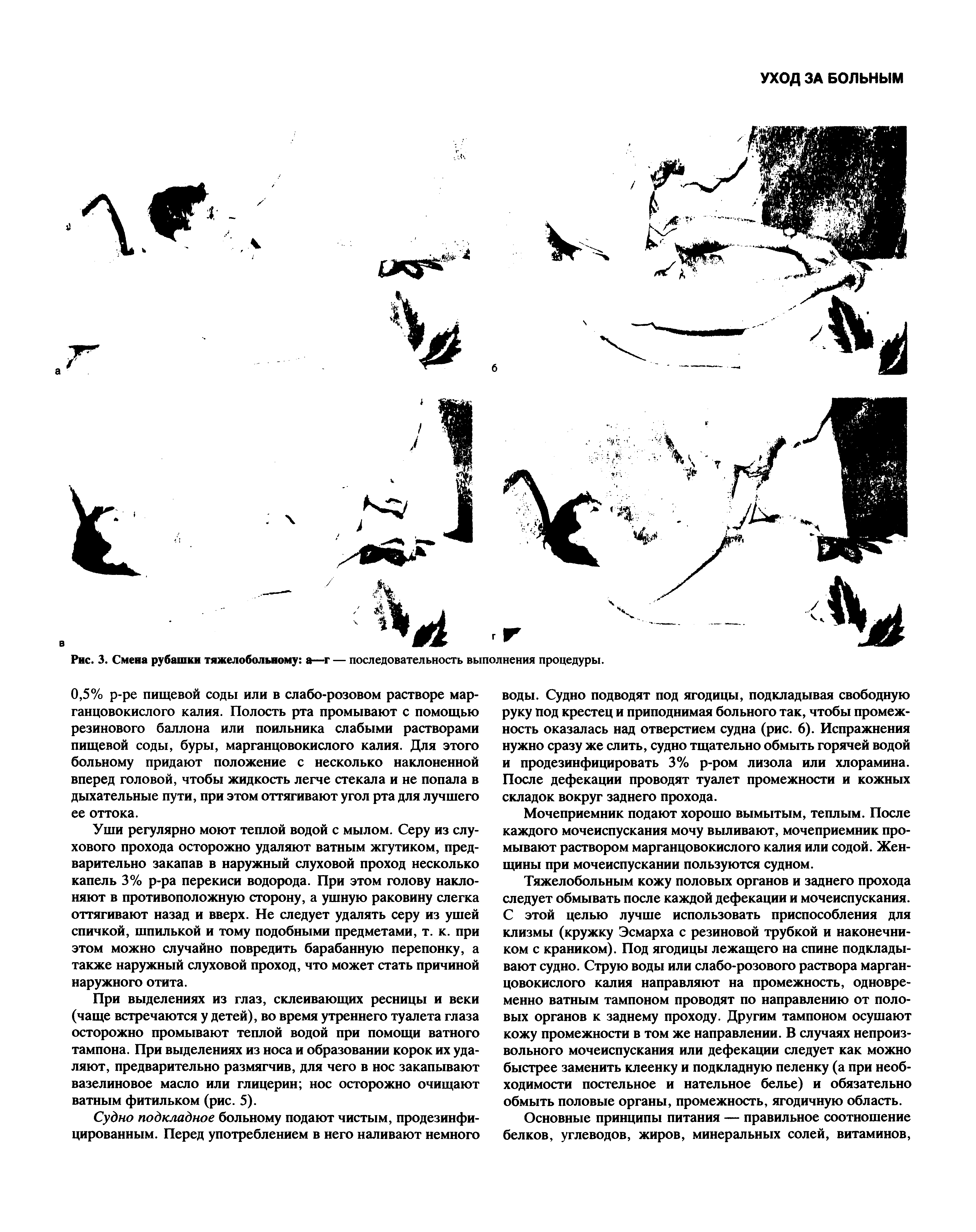 Рис. 3. Смена рубашки тяжелобольному а—г — последовательность выполнения процедуры.