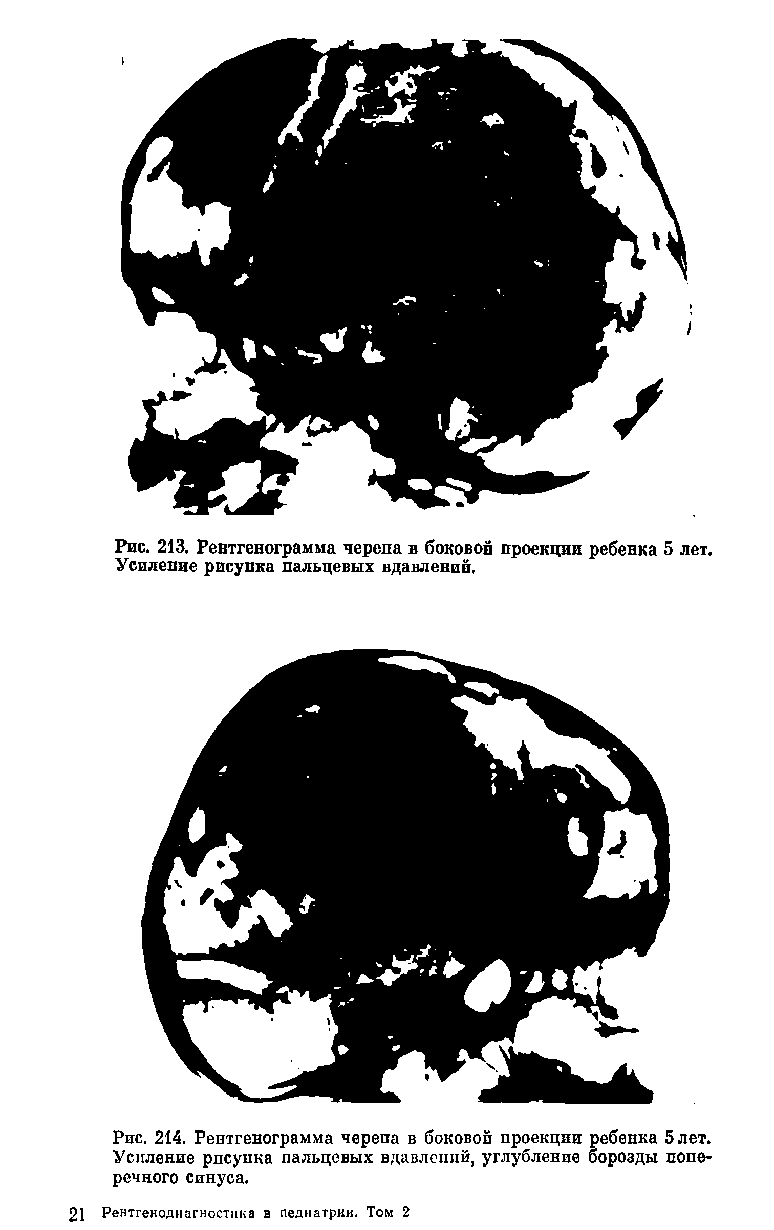Рис. 214. Рентгенограмма черепа в боковой проекции ребенка 5 лет. Усиление рпсупка пальцевых вдавлепий, углубление борозды поперечного синуса.
