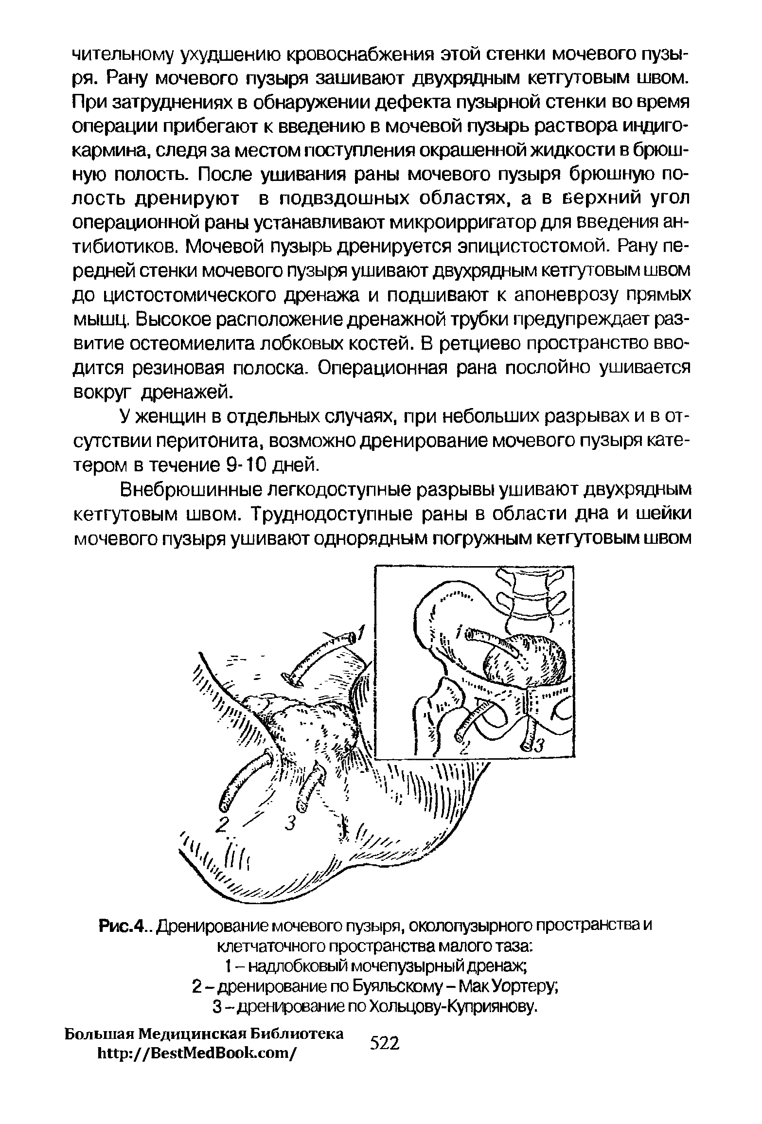 Рис.4.. Дренирование мочевого пузыря, околопузырного пространства и клетчаточного пространства малого таза ...