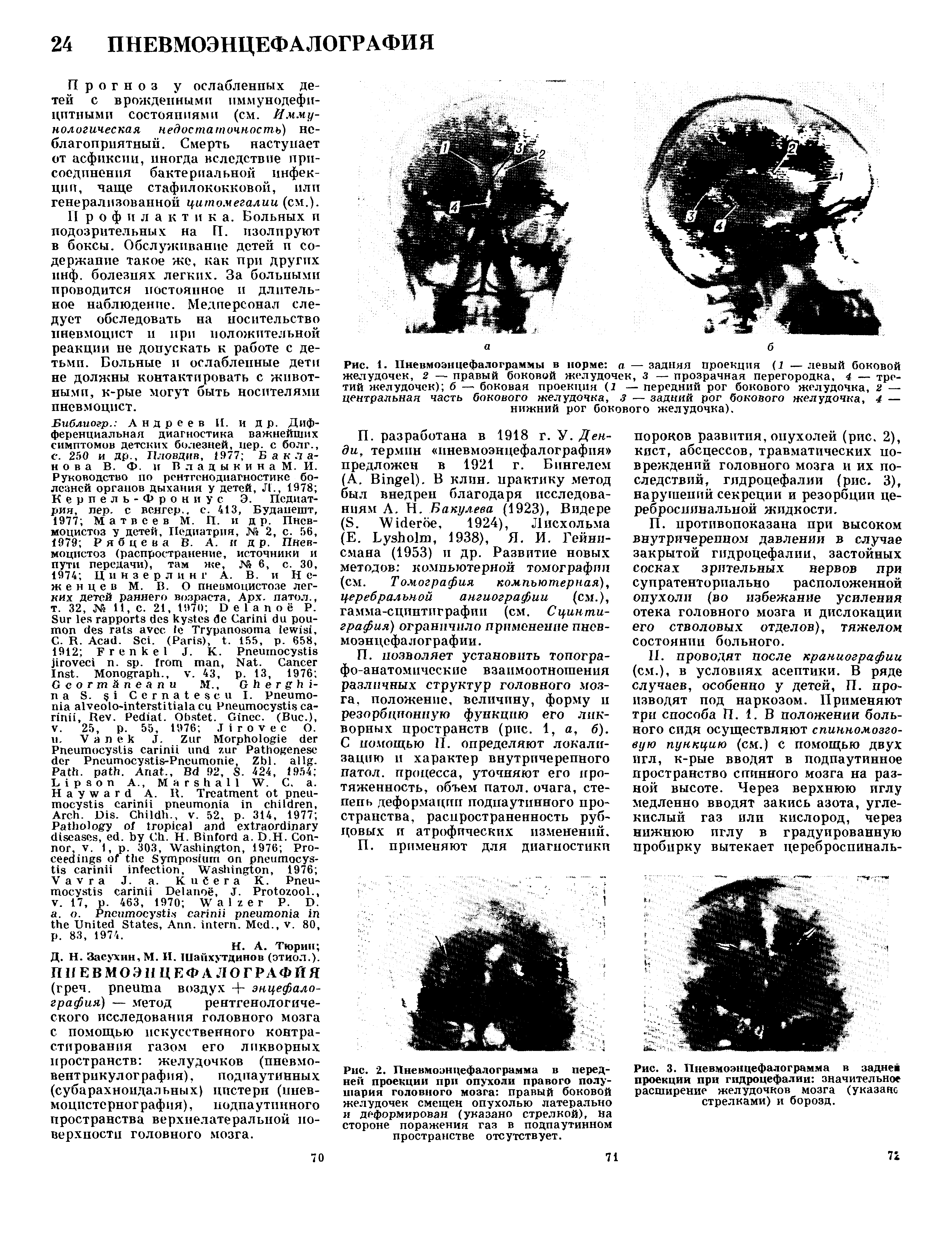 Рис. 2. Пневмоэнцефалограмма в передней проекции при опухоли правого полушария головного мозга правый боковой желудочек смещен опухолью латерально и деформирован (указано стрелкой), на стороне поражения газ в подпаутинном пространстве отсутствует.