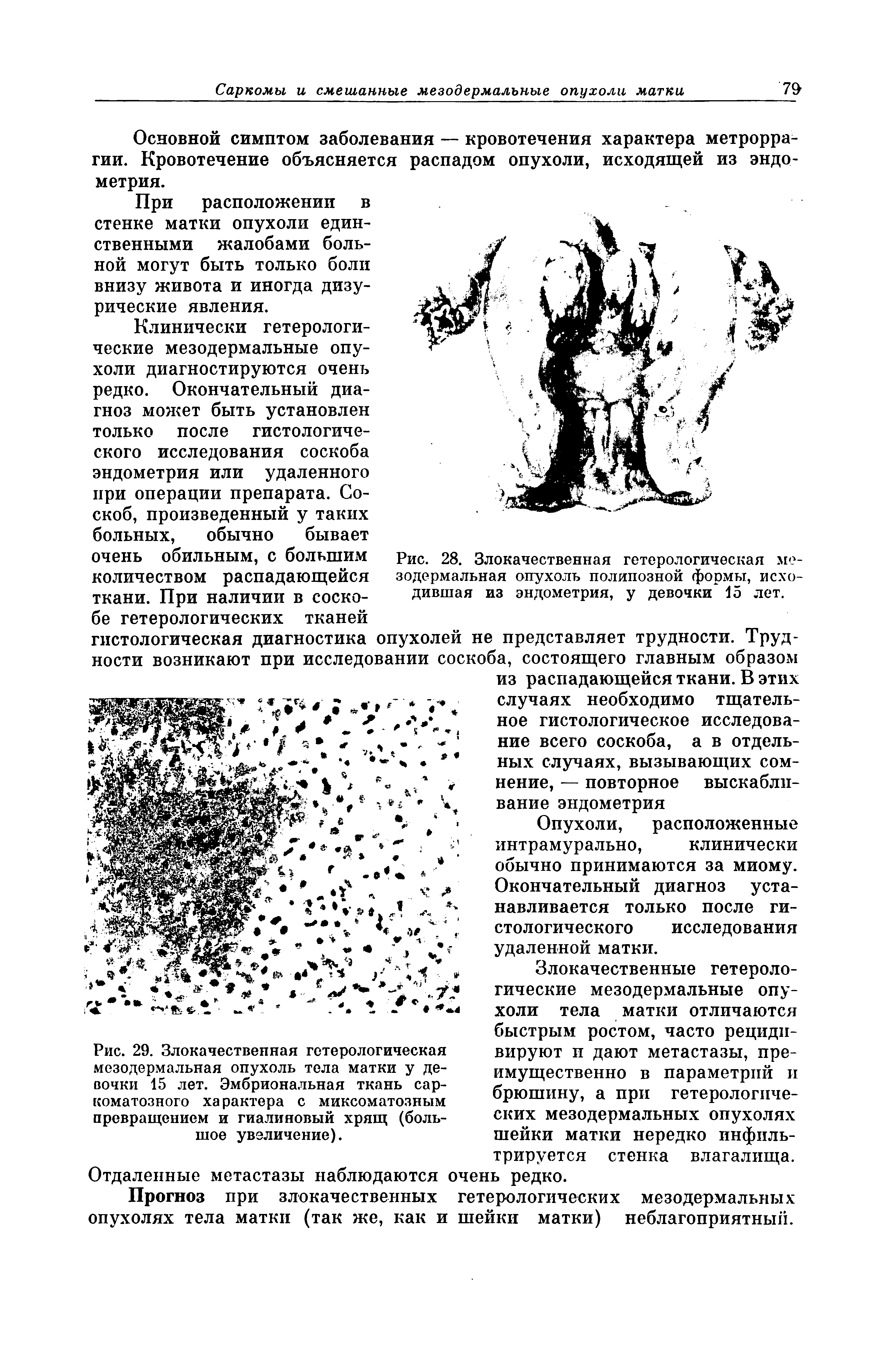 Рис. 29. Злокачественная гетерологическая мезодермальная опухоль тела матки у девочки 15 лет. Эмбриональная ткань саркоматозного характера с миксоматозным превращением и гиалиновый хрящ (большое увеличение).