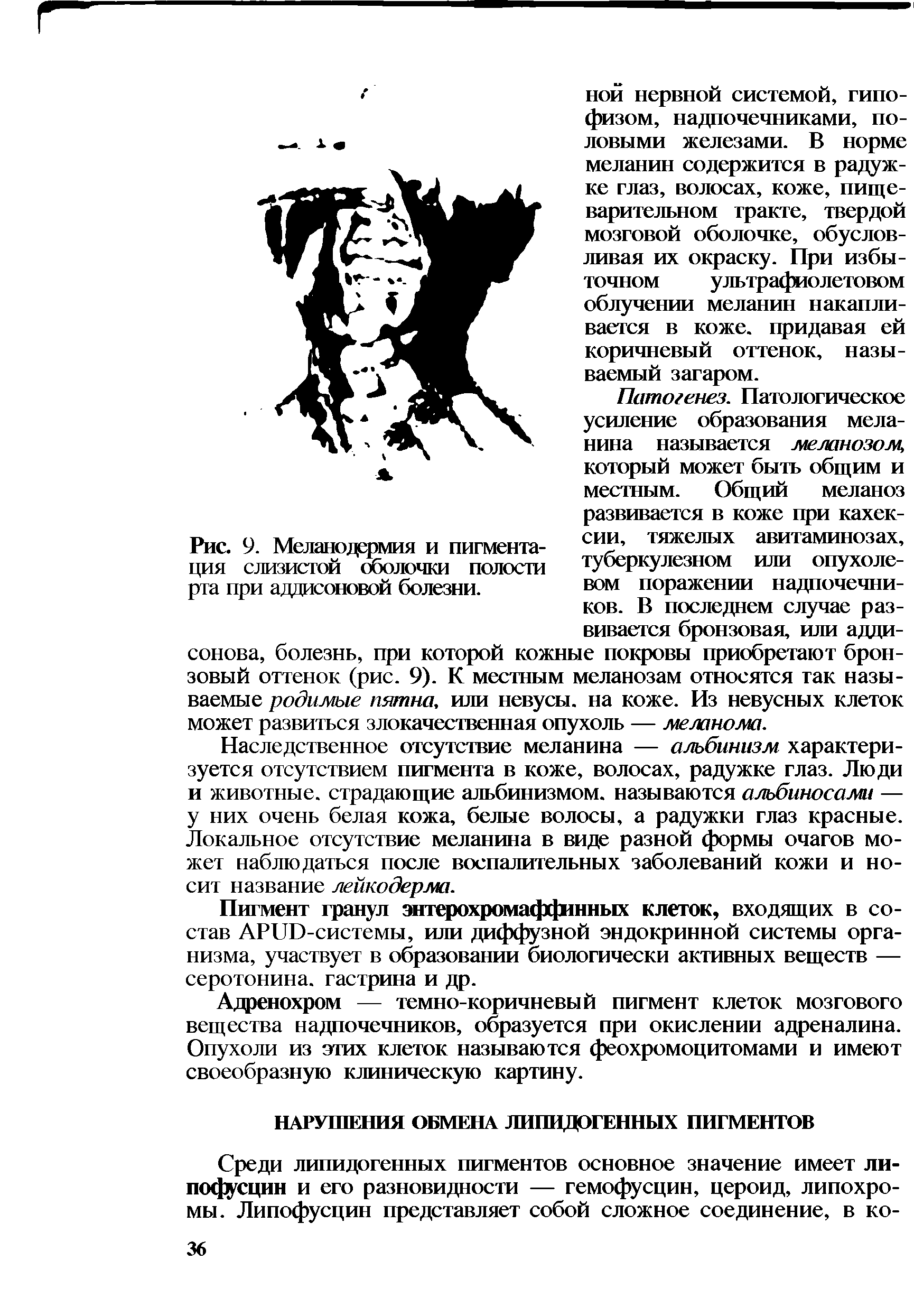 Рис. 9. Меланодермия и пигмента- с тяжелых авитаминозах, ция слизистой оболочки полости туберкулезном или опухоле рта при аддисоновой болезни. вом поражении надпочечни-...