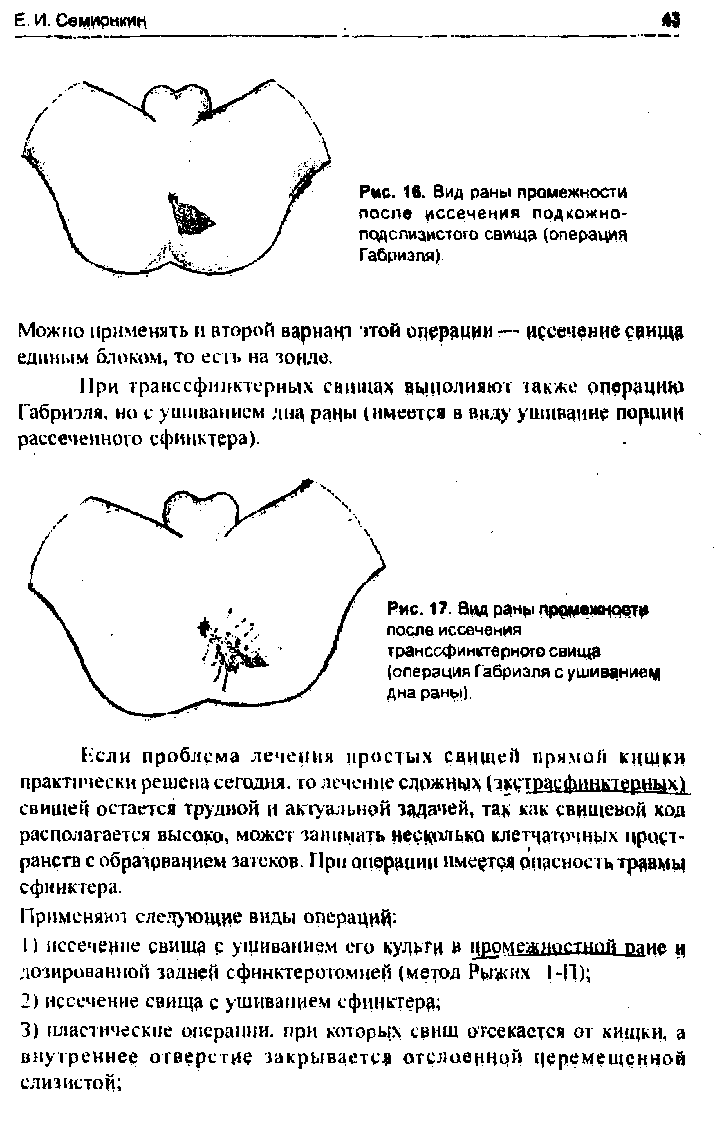 Рис. 17. Вцд раны лррмежнрвти после иссечения транссфинктерного свища (операция Габриэля с ушиванием дна раны).