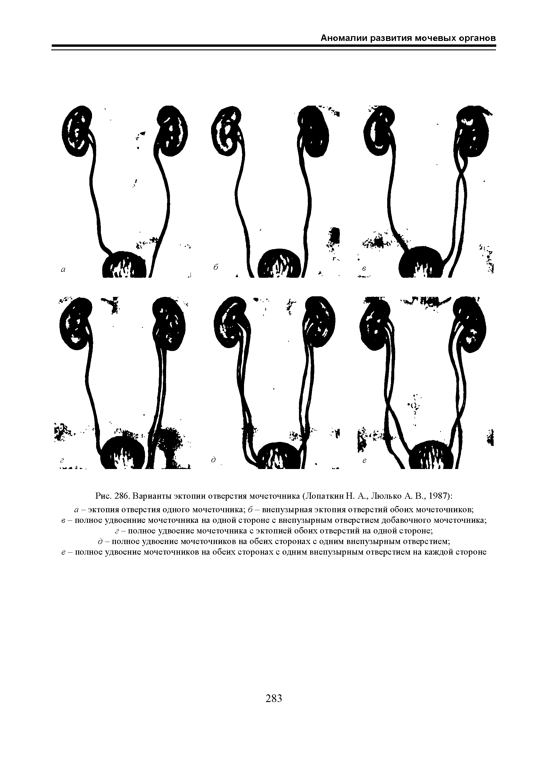 Рис. 286. Варианты эктопии отверстия мочеточника (Лопаткин Н. А., Люлько А. В., 1987) ...