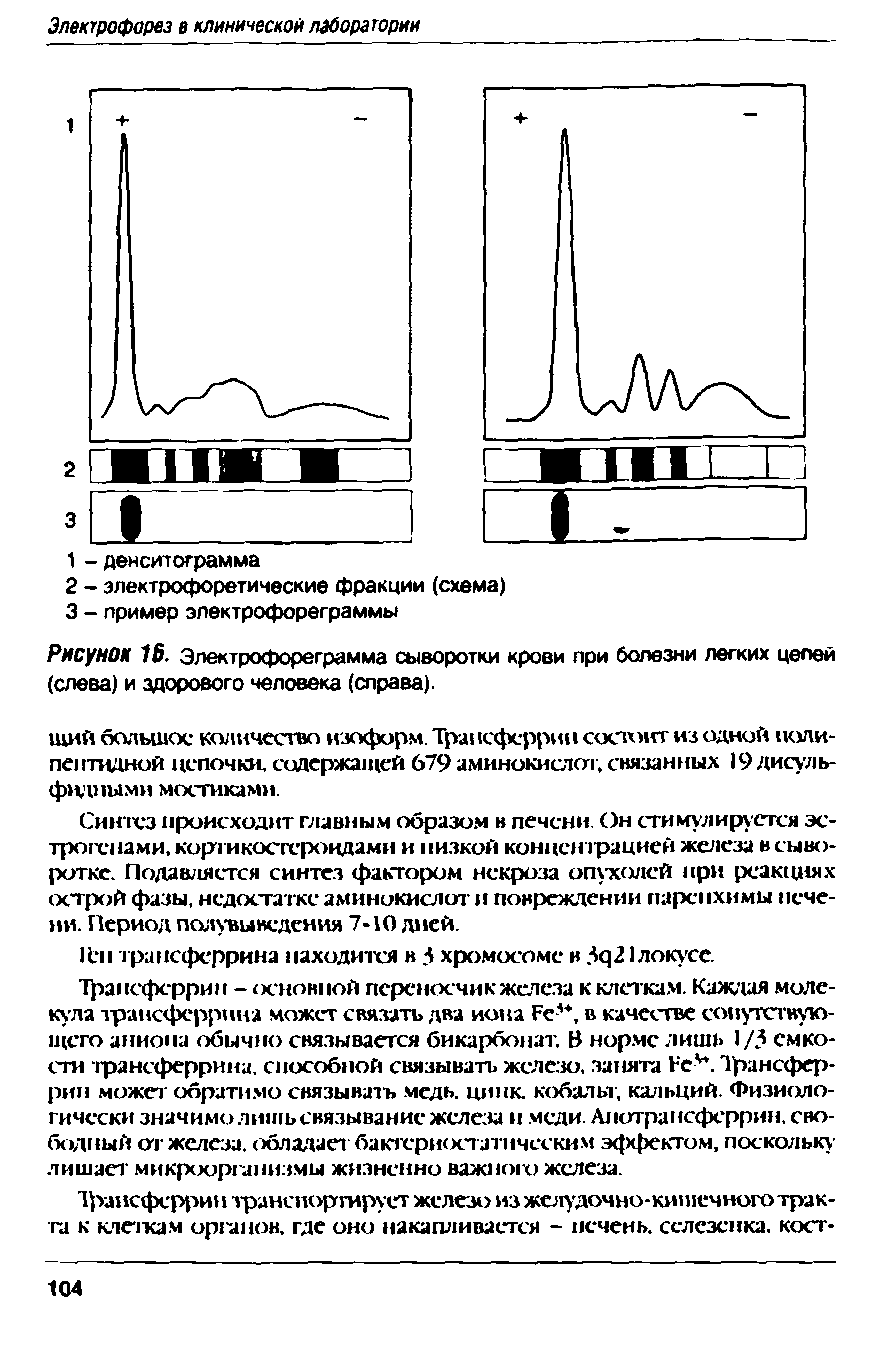 Рисунок 16. Электрофореграмма сыворотки крови при болезни легких цепей (слева) и здорового человека (справа).