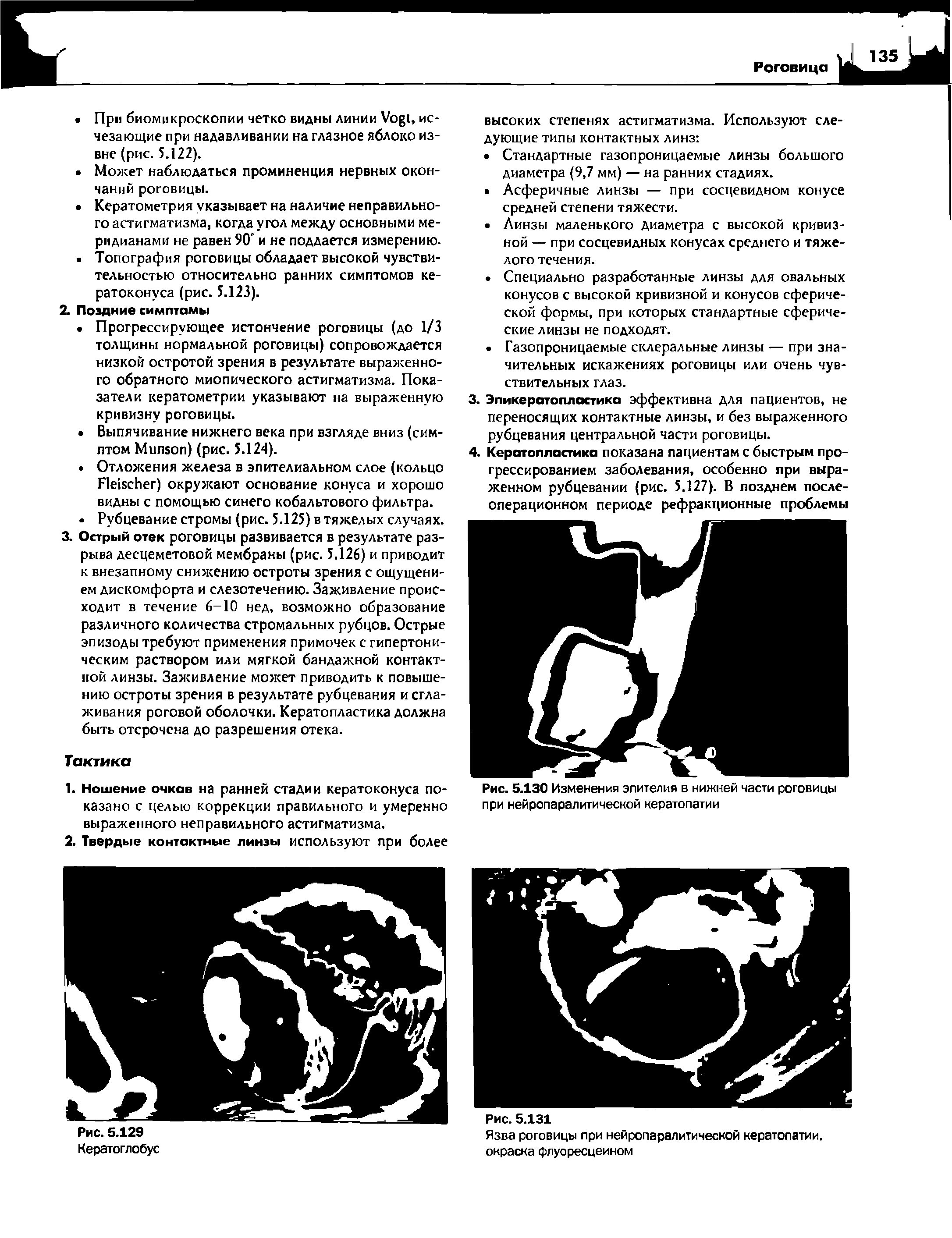 Рис. 5.130 Изменения эпителия в нижней части роговицы при нейропаралитической кератопатии...