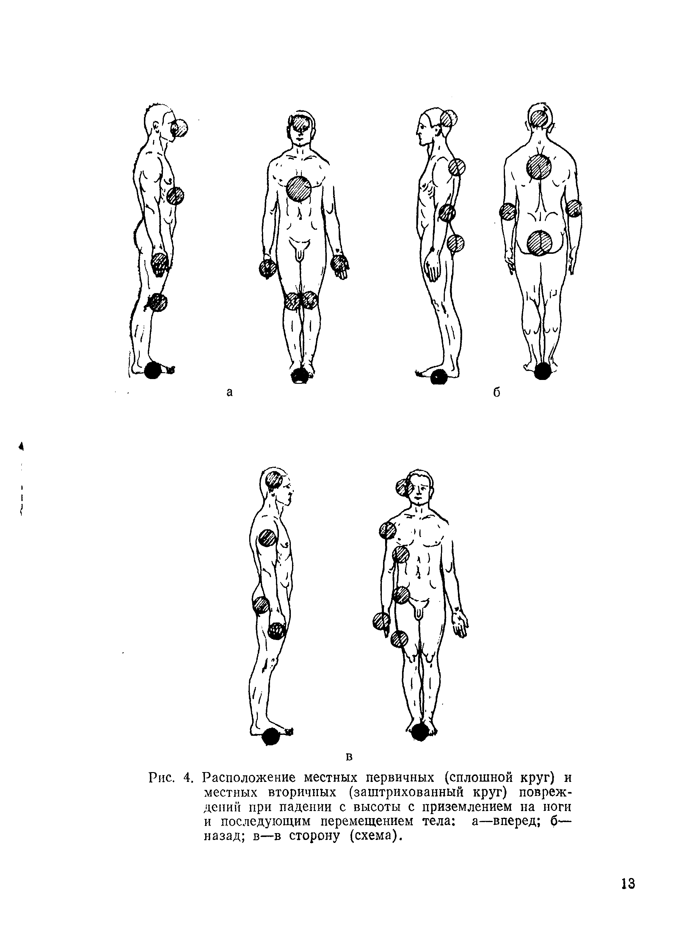 Рис. 4. Расположение местных первичных (сплошной круг) и местных вторичных (заштрихованный круг) повреждений при падении с высоты с приземлением на ноги и последующим перемещением тела а—вперед б— назад в—в сторону (схема).