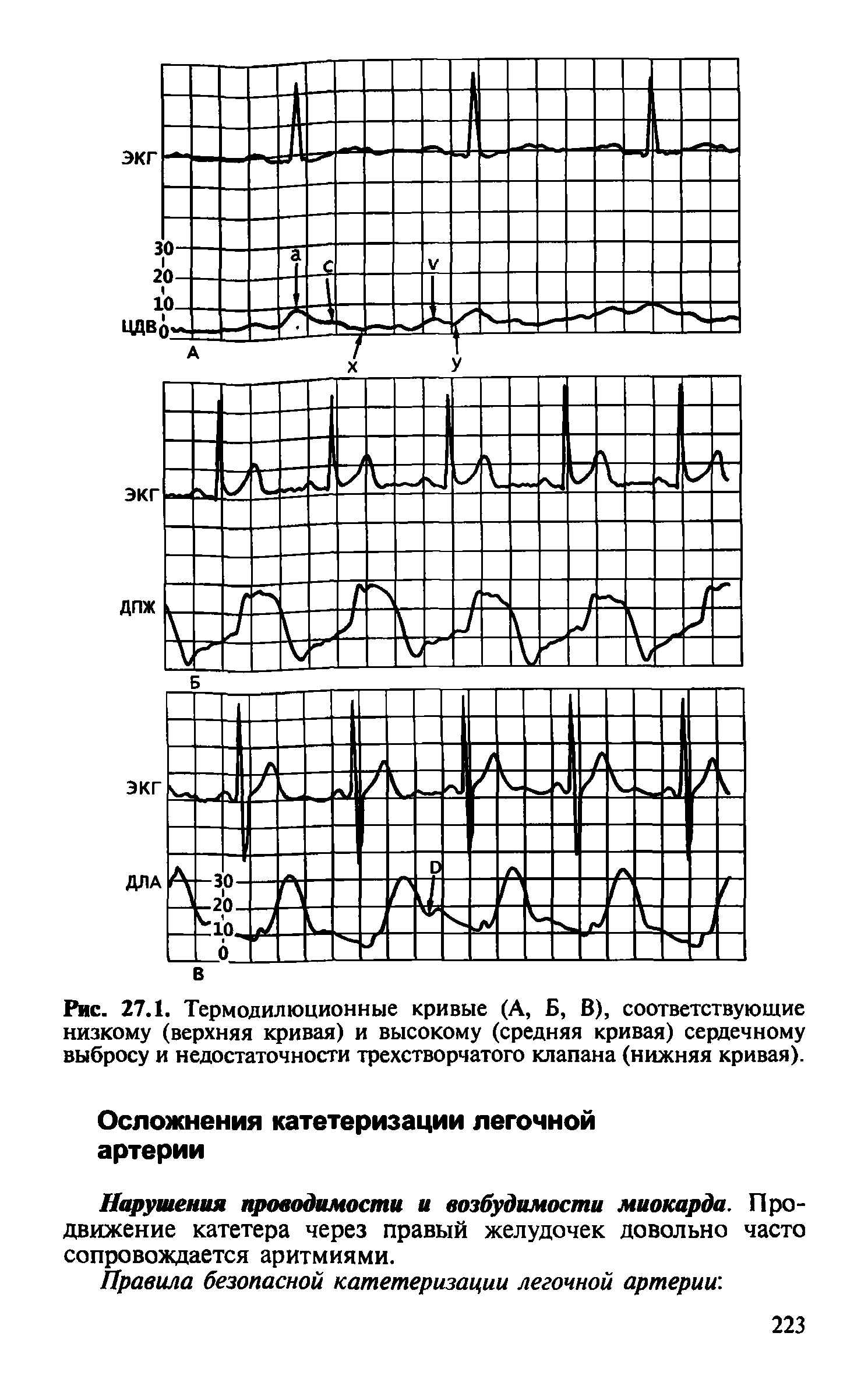 Рис. 27.1. Термодилюционные кривые (А, Б, В), соответствующие низкому (верхняя кривая) и высокому (средняя кривая) сердечному выбросу и недостаточности трехстворчатого клапана (нижняя кривая).