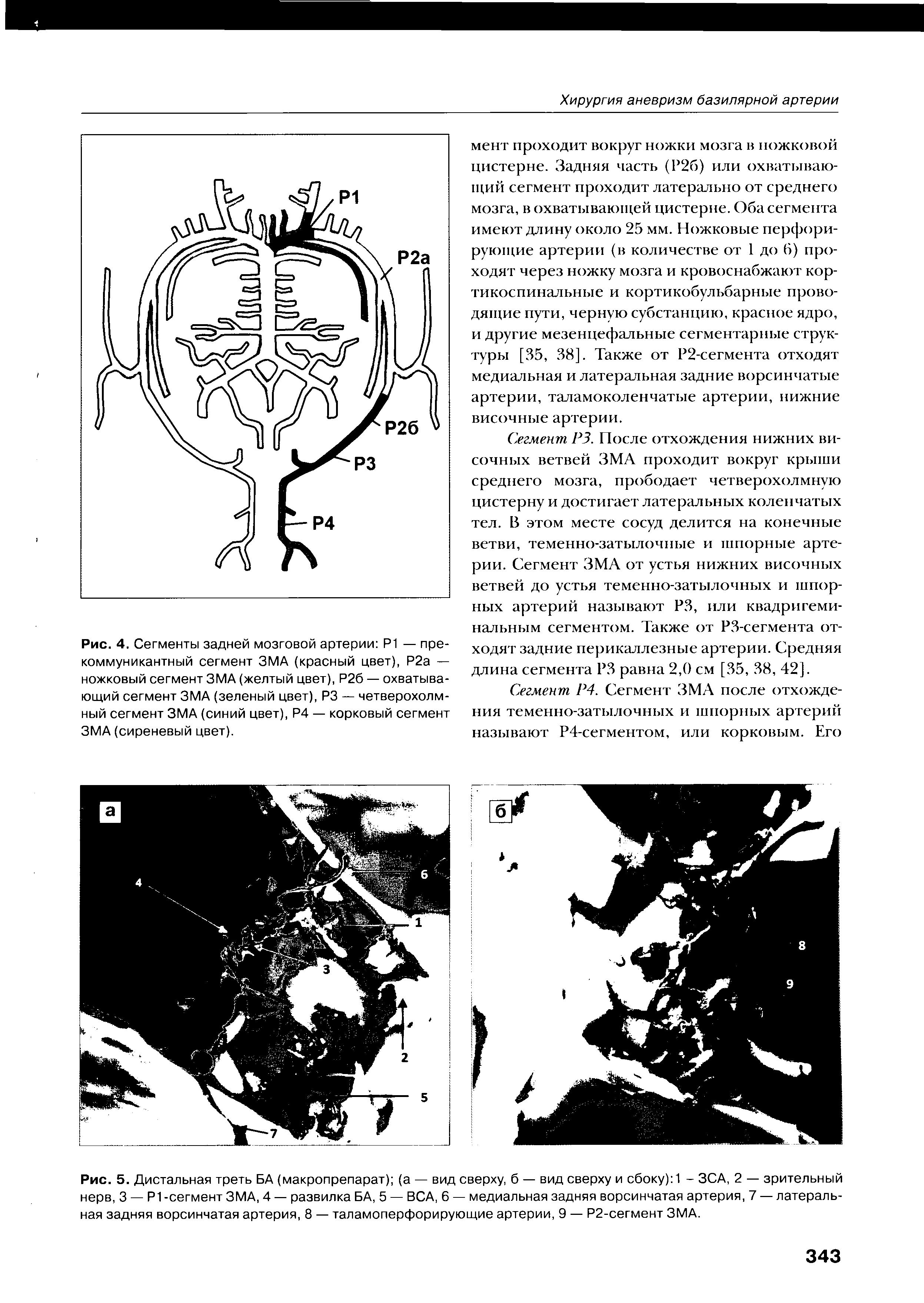 Рис. 5. Дистальная треть БА (макропрепарат) (а — вид сверху, б — вид сверху и сбоку) 1 - ЗСА, 2 — зрительный нерв, 3 — Р1 -сегмент ЗМА, 4 — развилка БА, 5 — ВСА, 6 — медиальная задняя ворсинчатая артерия, 7 — латеральная задняя ворсинчатая артерия, 8 — таламоперфорирующие артерии, 9 — Р2-сегмент ЗМА.