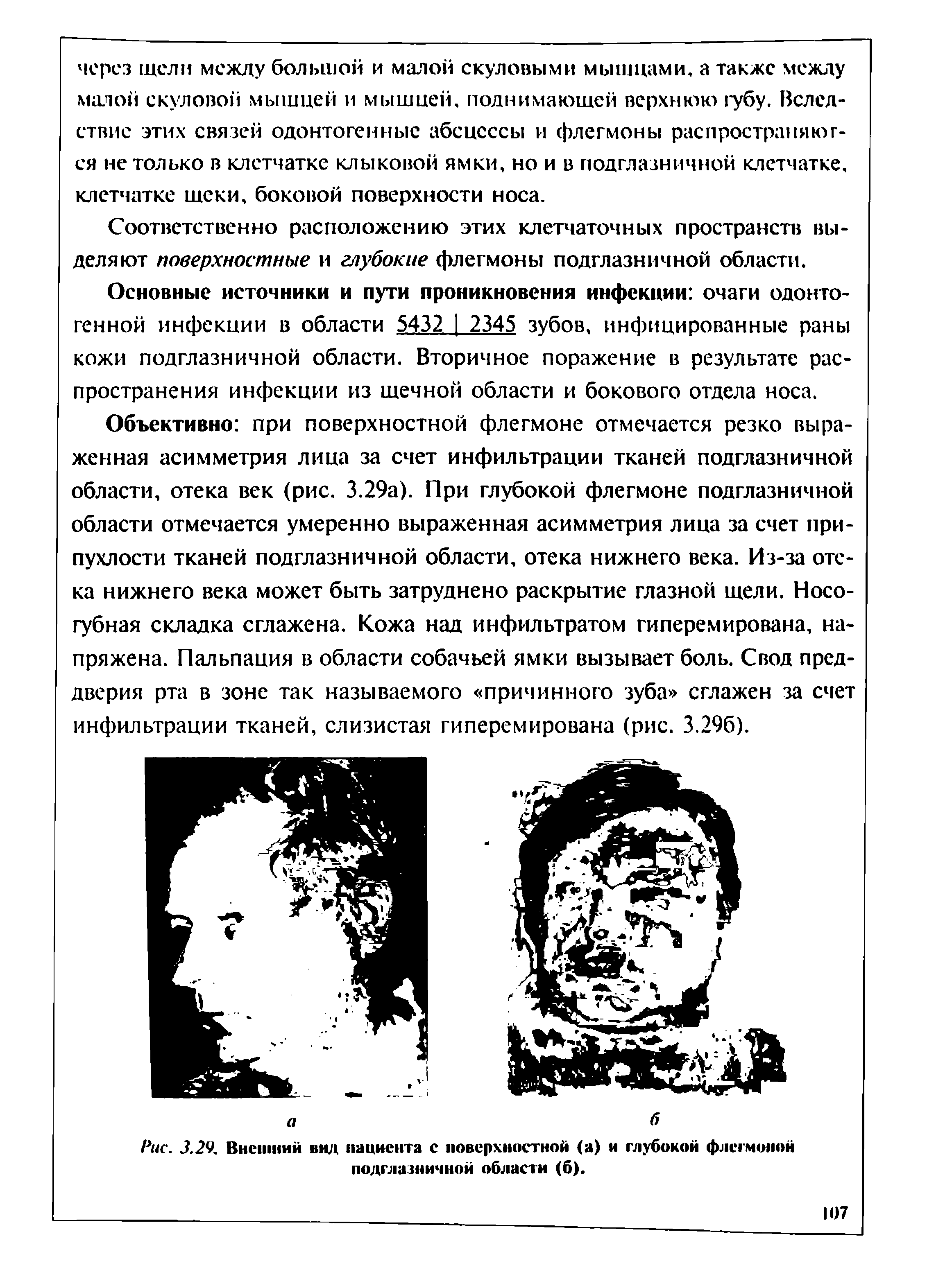 Рис. 3.29. Внешний вид пациента с поверхностной (а) и глубокой флегмоной подглазничной области (б).