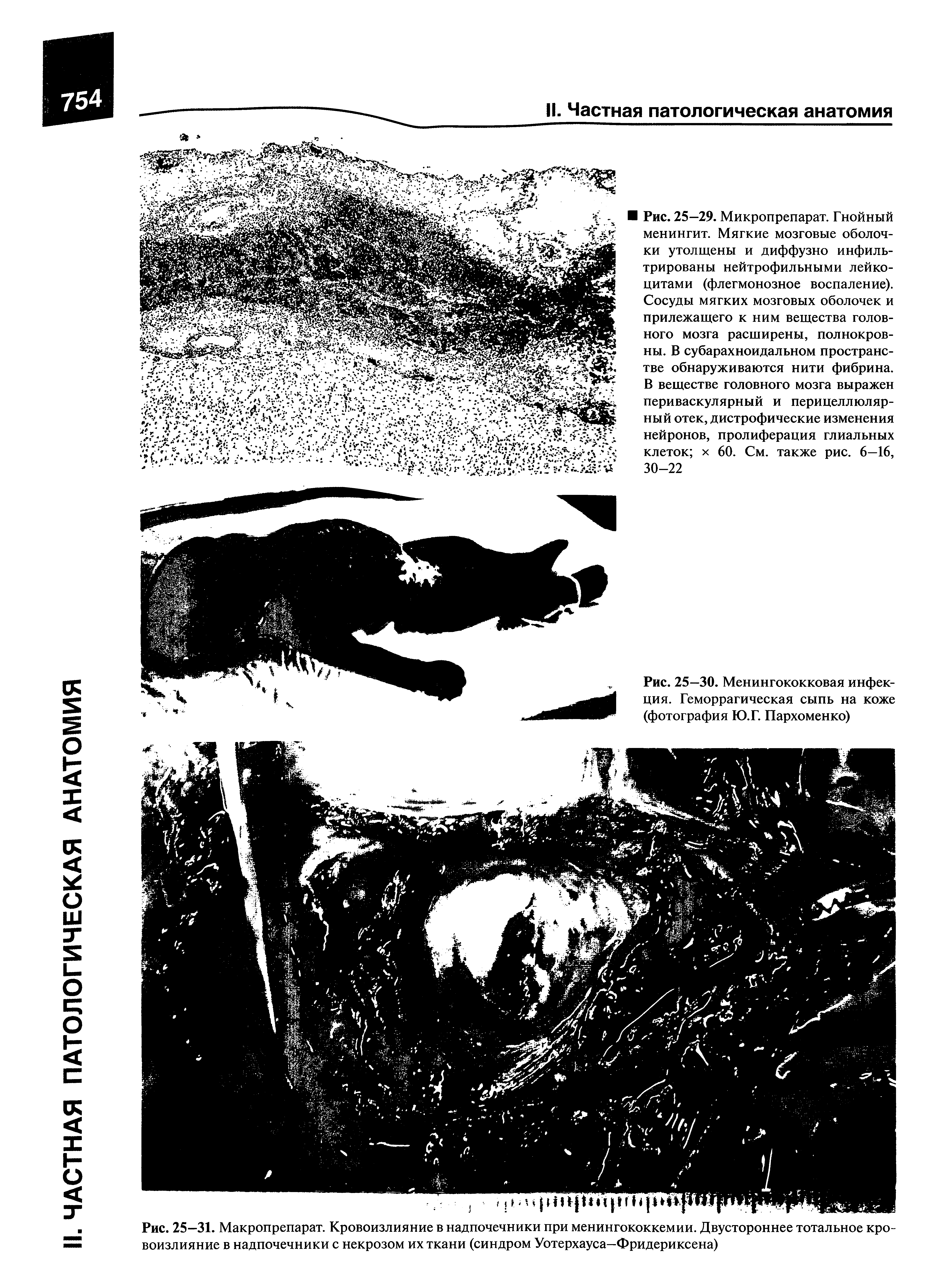 Рис. 25—31. Макропрепарат. Кровоизлияние в надпочечники при менингококкемии. Двустороннее тотальное кровоизлияние в надпочечники с некрозом их ткани (синдром Уотерхауса—Фридериксена)...