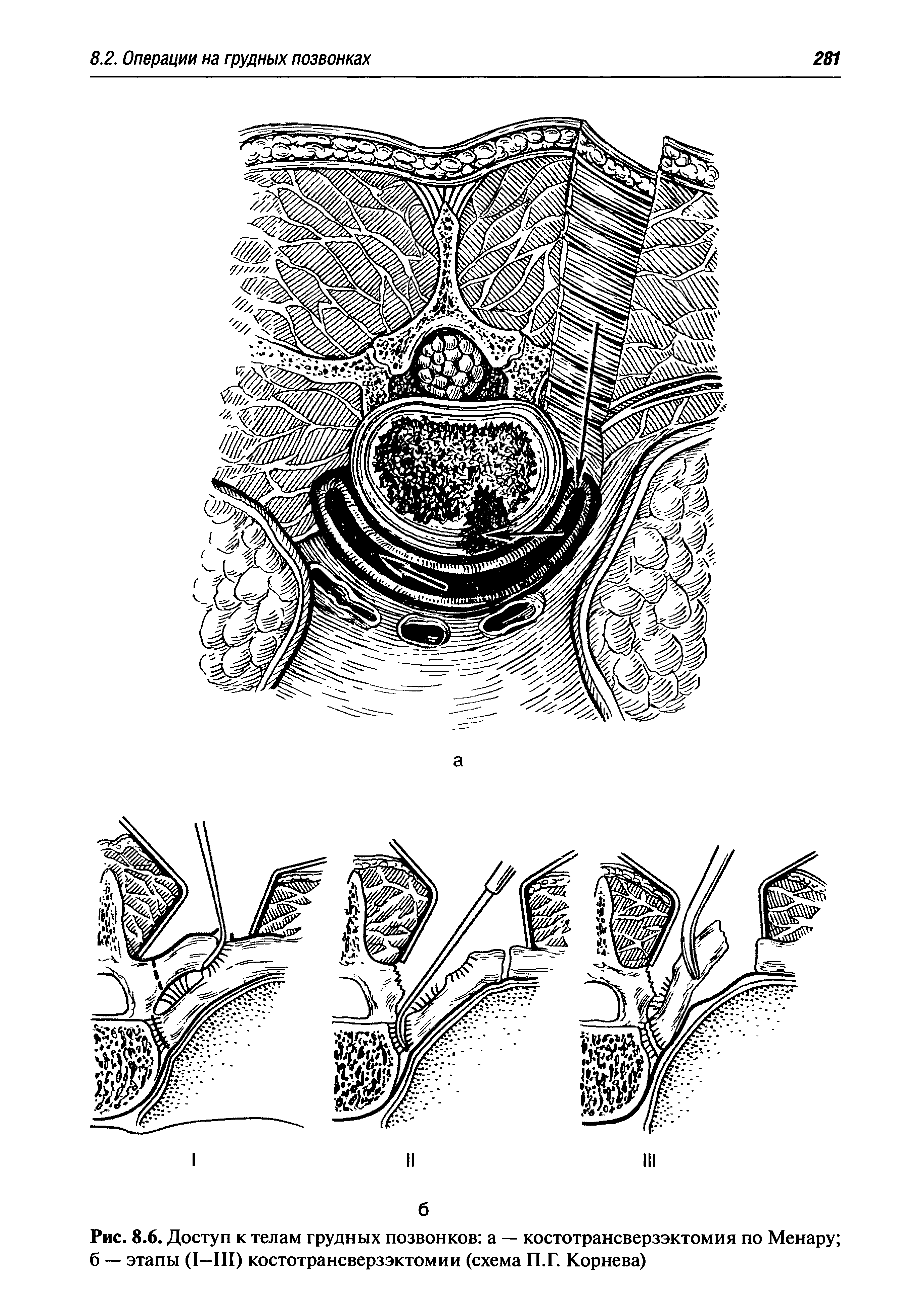 Рис. 8.6. Доступ к телам грудных позвонков а — костотрансверзэктомия по Менару ...