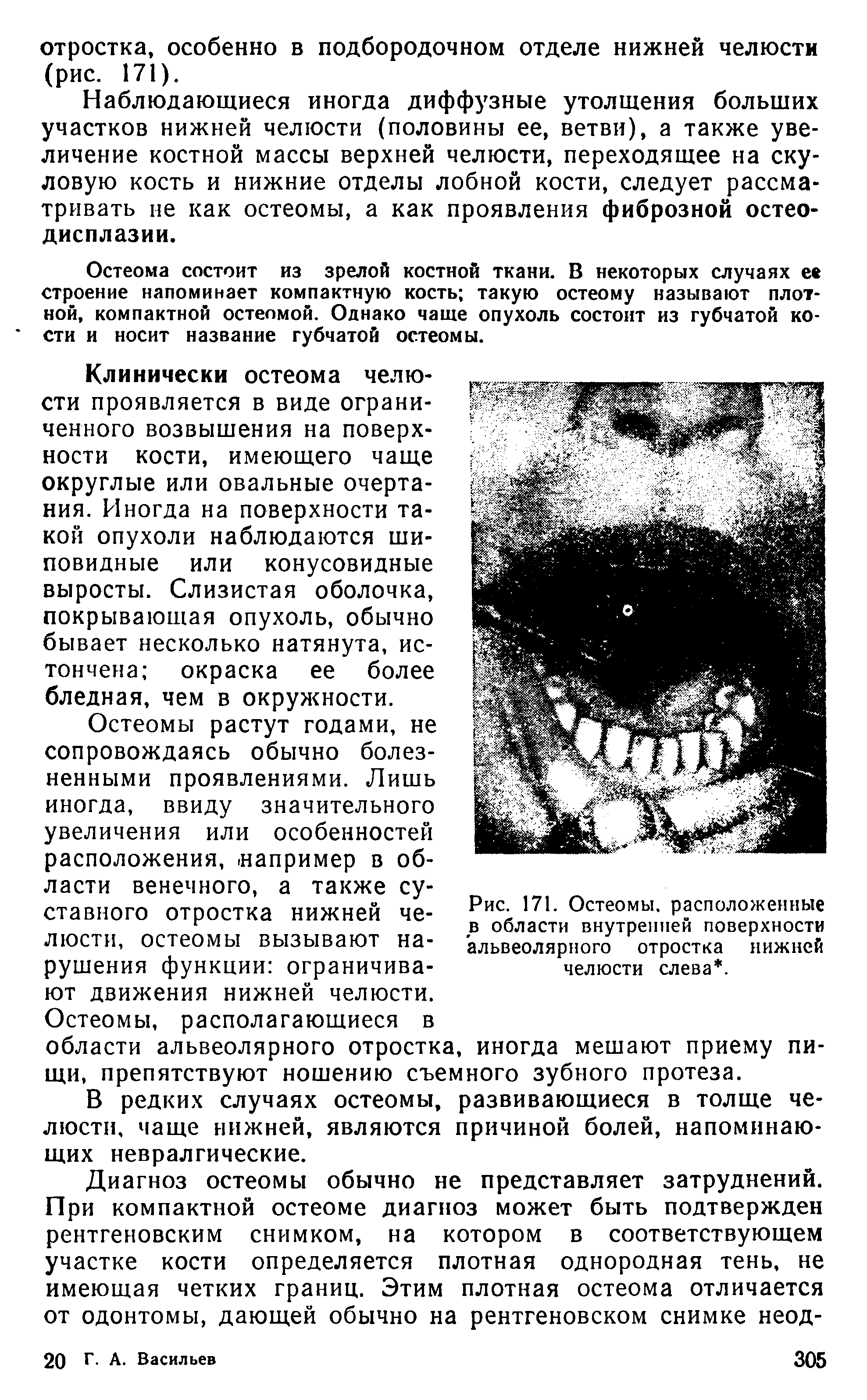 Рис. 171. Остеомы, расположенные в области внутренней поверхности альвеолярного отростка нижней челюсти слева. ...