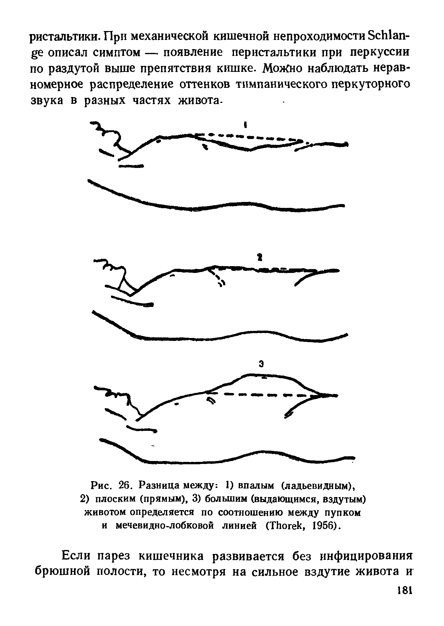 Рис. 26. Разница между 1) впалым (ладьевидным), 2) плоским (прямым), 3) большим (выдающимся, вздутым) животом определяется по соотношению между пупком и мечевидно-лобковой линией (ТЬогек, 1956).