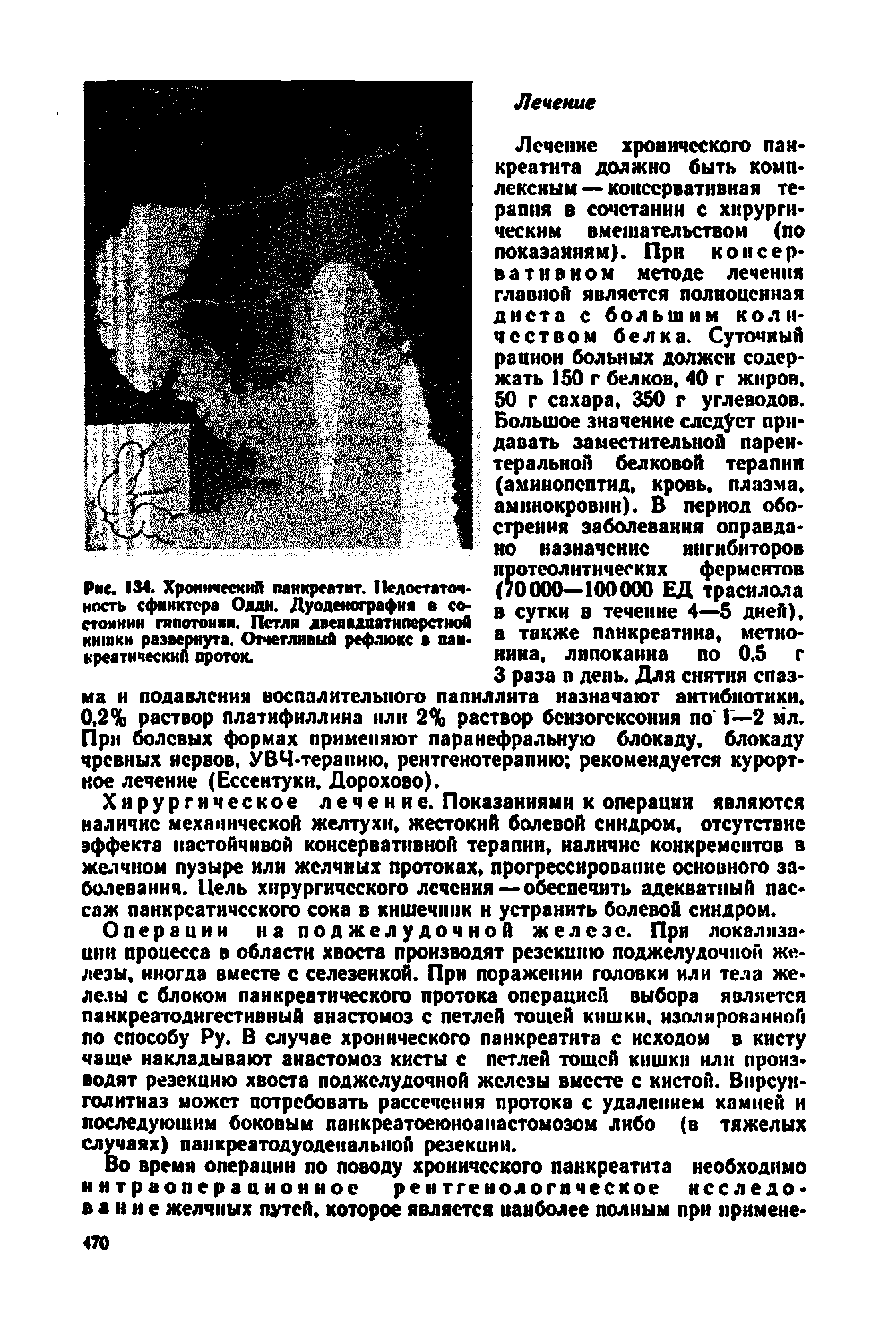 Рис. 134. Хронический панкреатит. Недостаточность сфинктера Одди. Дуоденография в состоянии гипотонии. Петля двенадцатиперстной кишки развернута. Отчетливый рефлюкс в панкреатический проток.