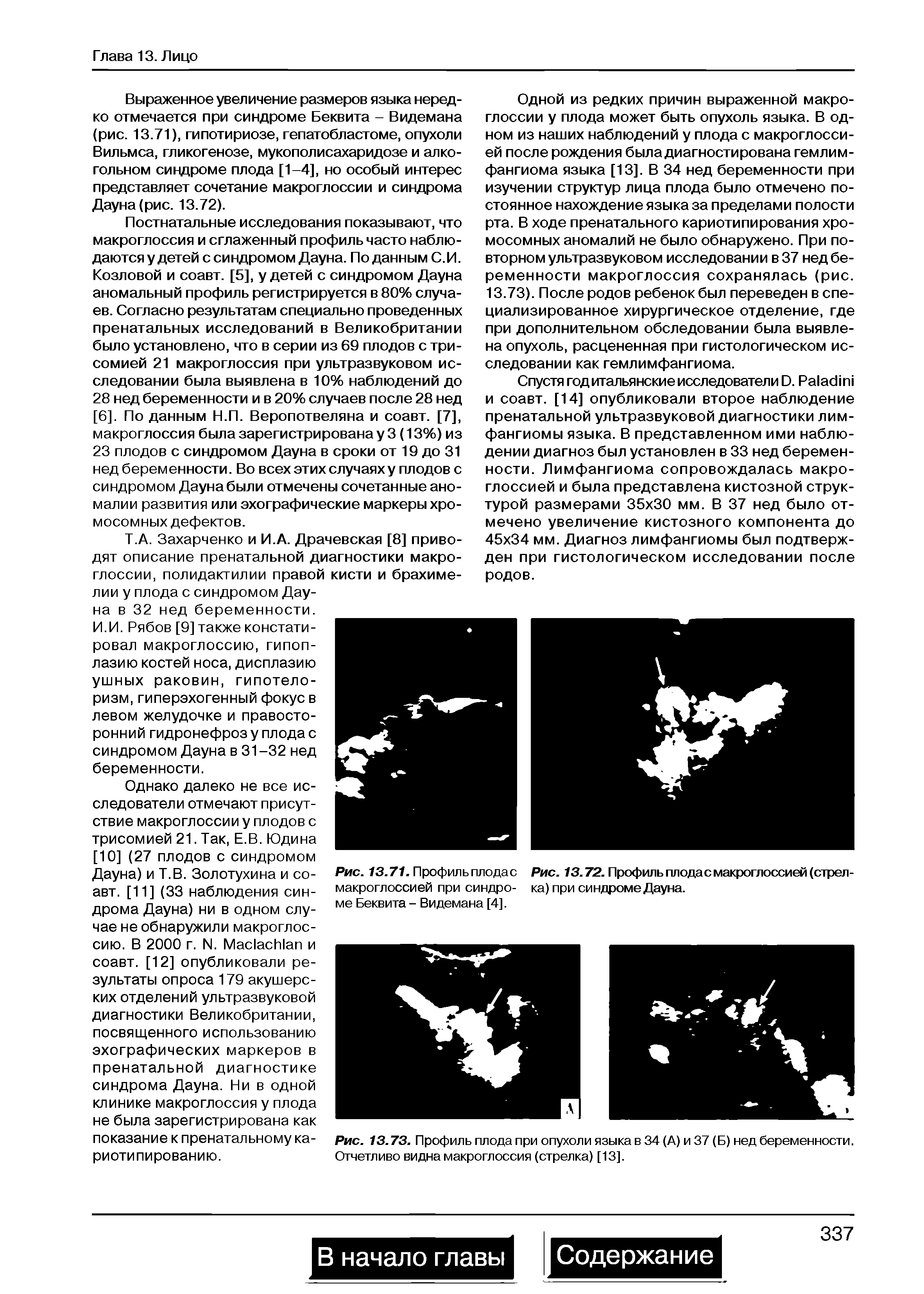 Рис. 13.73. Профиль плода при опухоли языка в 34 (А) и 37 (Б) нед беременности. Отчетливо видна макроглоссия (стрелка) [13].