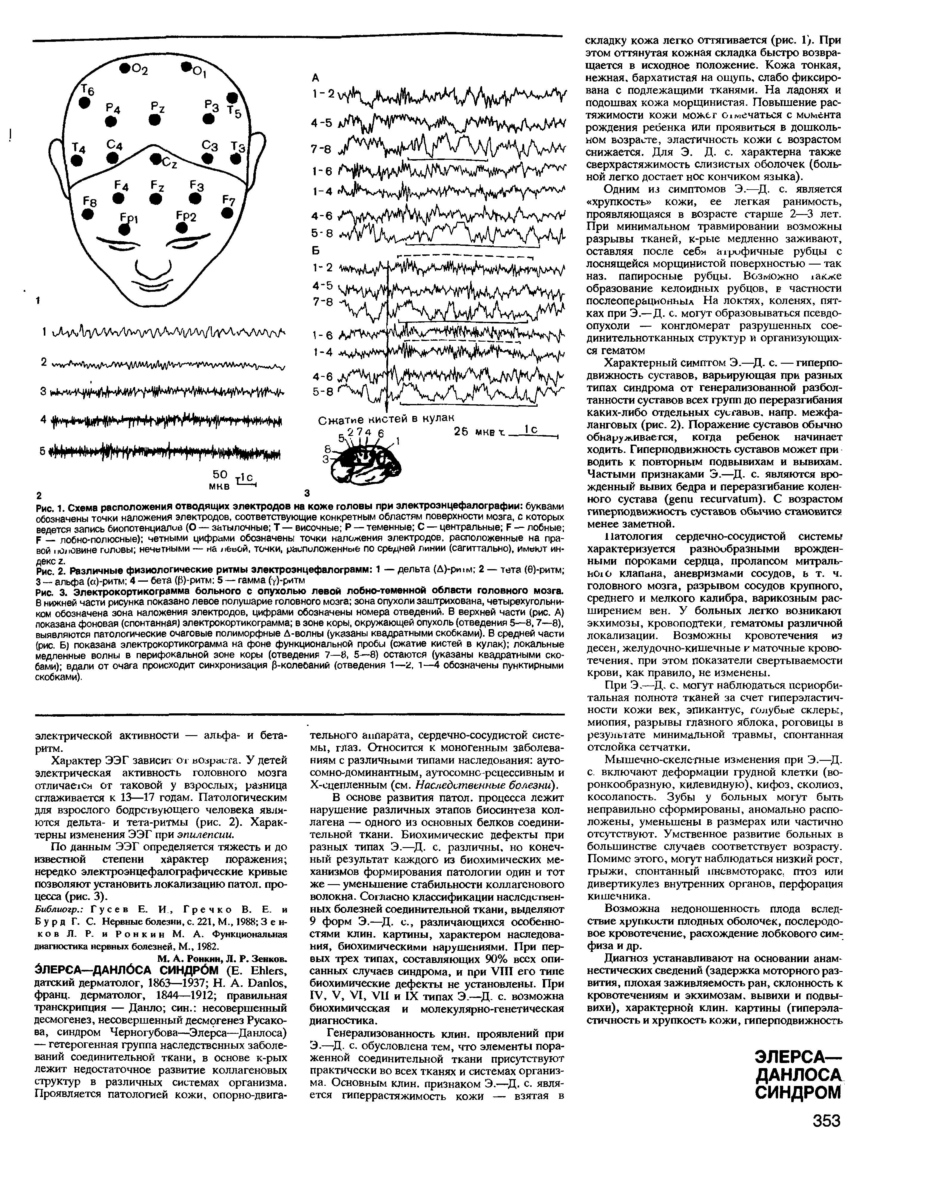 Рис. 2. Различные физиологические ритмы электроэнцефалограмм 1 — дельта (Д)-рИ м 2 — тета (б)-ритм 3 — альфа (а)-ритм 4 — бета (Р)-ритм 5 — гамма (у)-ритм...