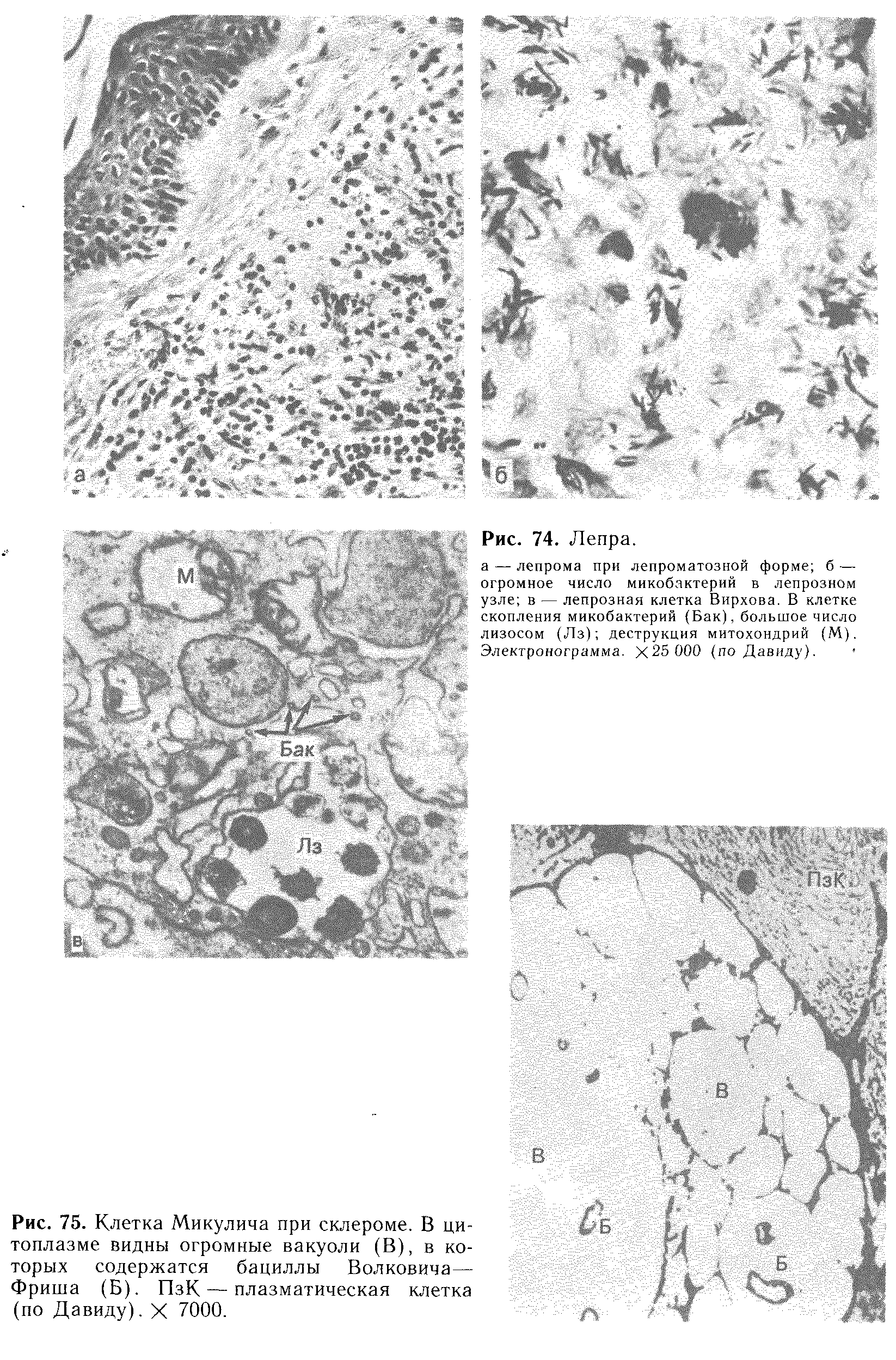 Рис. 75. Клетка Микулича при склероме. В цитоплазме видны огромные вакуоли (В), в которых содержатся бациллы Волковича— Фриша (Б). ПзК — плазматическая клетка (по Давиду). X 7000.