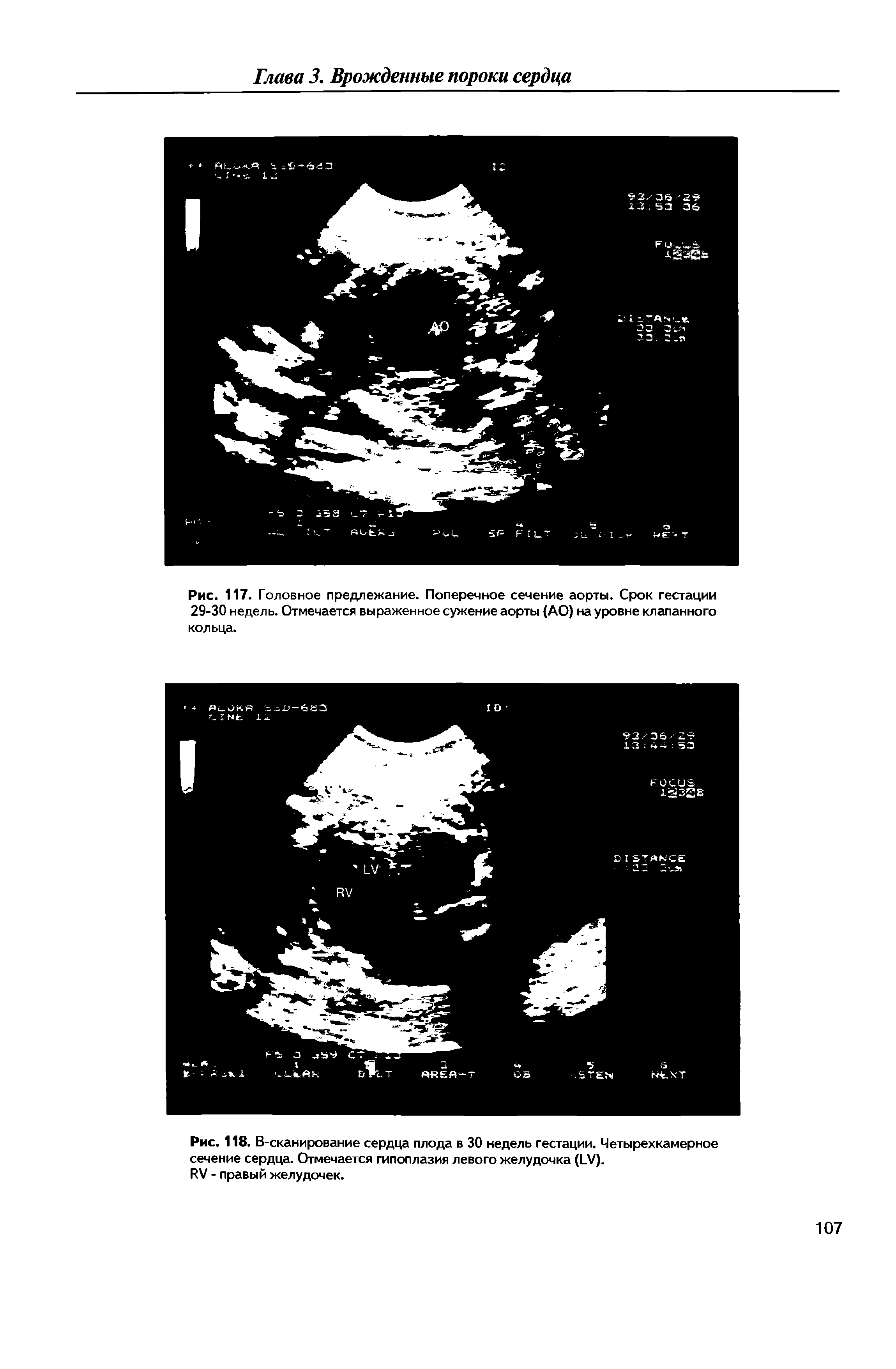 Рис. 117. Головное предлежание. Поперечное сечение аорты. Срок гестации...