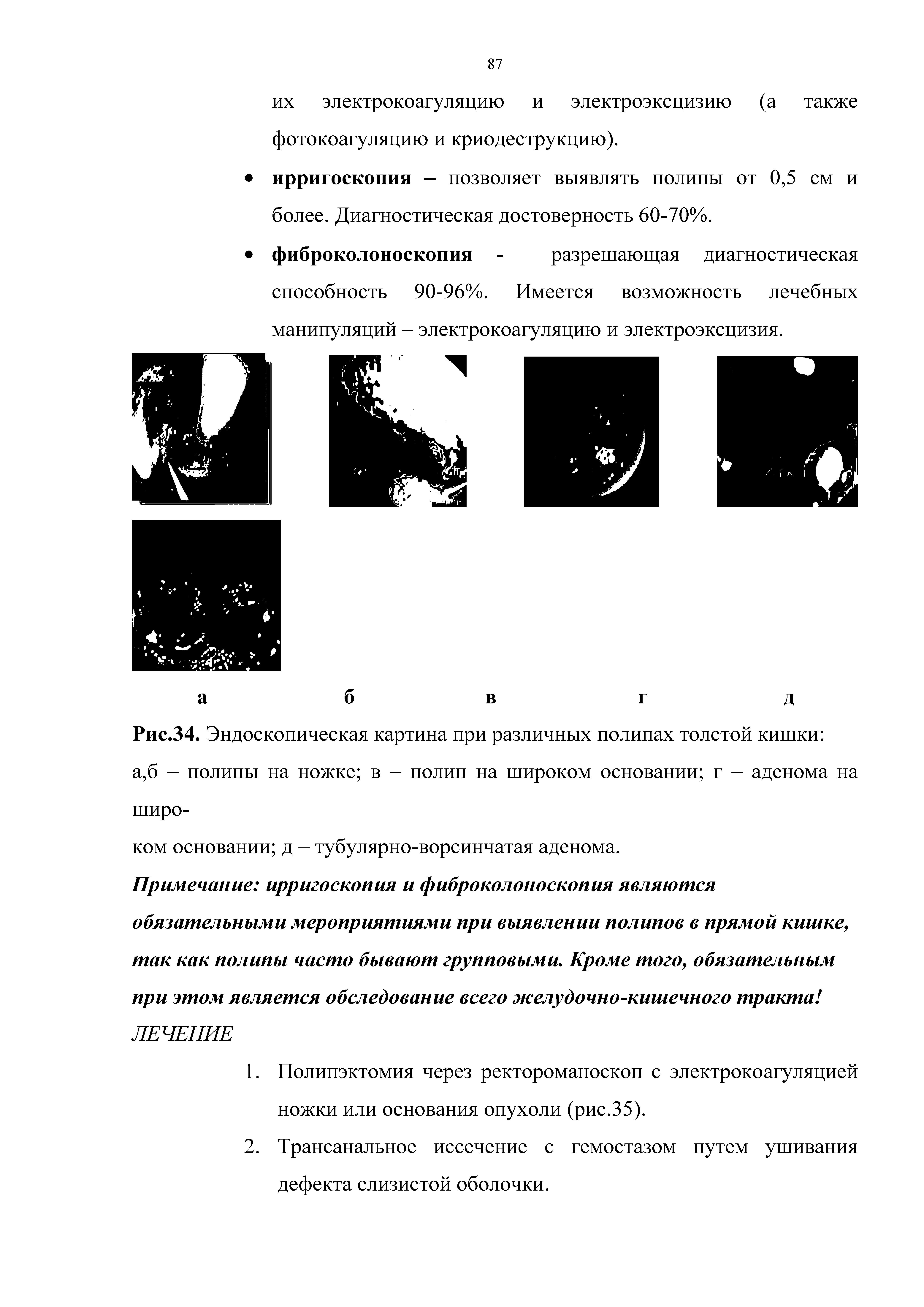 Рис.34. Эндоскопическая картина при различных полипах толстой кишки а,б - полипы на ножке в - полип на широком основании г - аденома на широком основании д - тубулярно-ворсинчатая аденома.